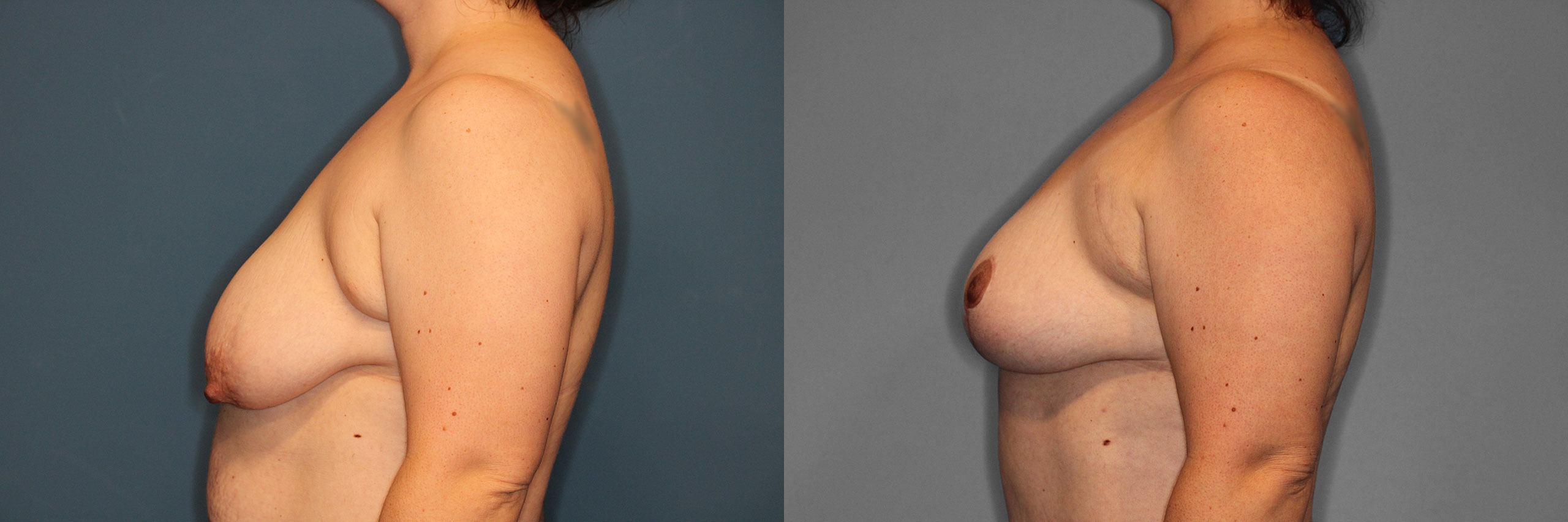Breast Lift Before and After photo by Dr. Abigail Rodriguez in Houston, TX