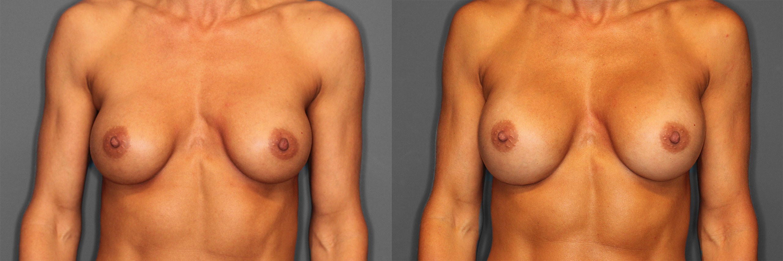 Breast Revision Before and After photo by Dr. Abigail Rodriguez in Houston, TX