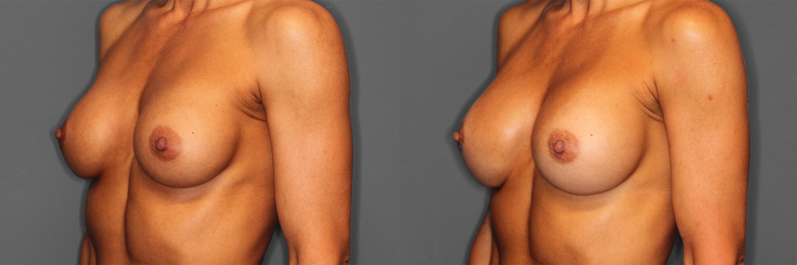 Breast Revision Before and After photo by Dr. Abigail Rodriguez in Houston, TX