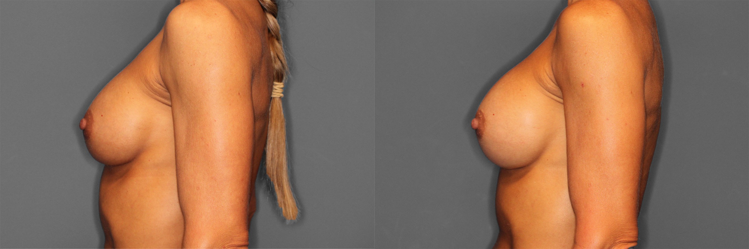 Breast Revision Before and After photo by Dr. Abigail Rodriguez in Houston, TX