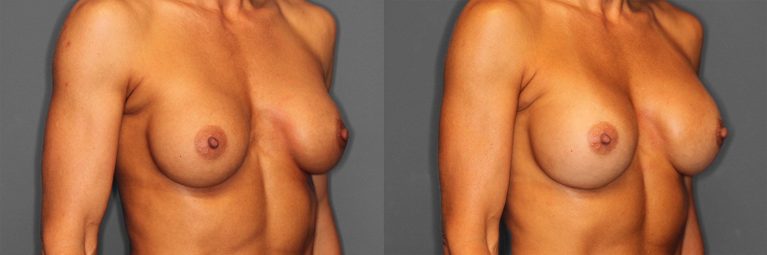 Breast Revision Before and After photo by Dr. Abigail Rodriguez in Houston, TX
