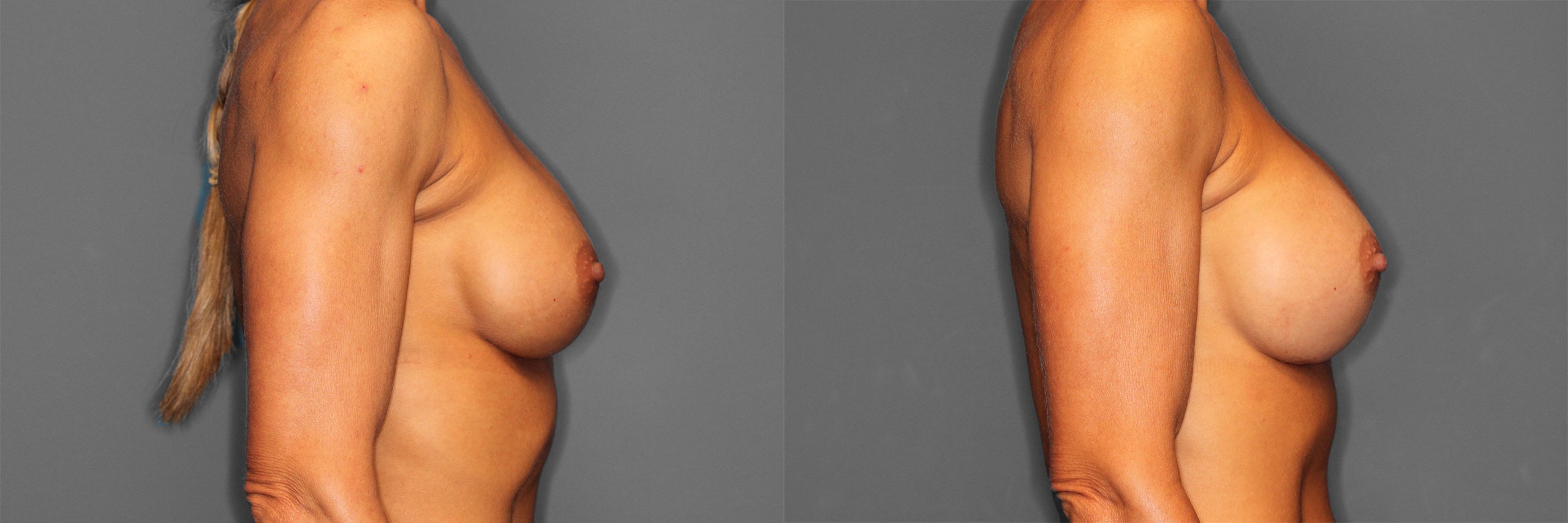 Breast Revision Before and After photo by Dr. Abigail Rodriguez in Houston, TX
