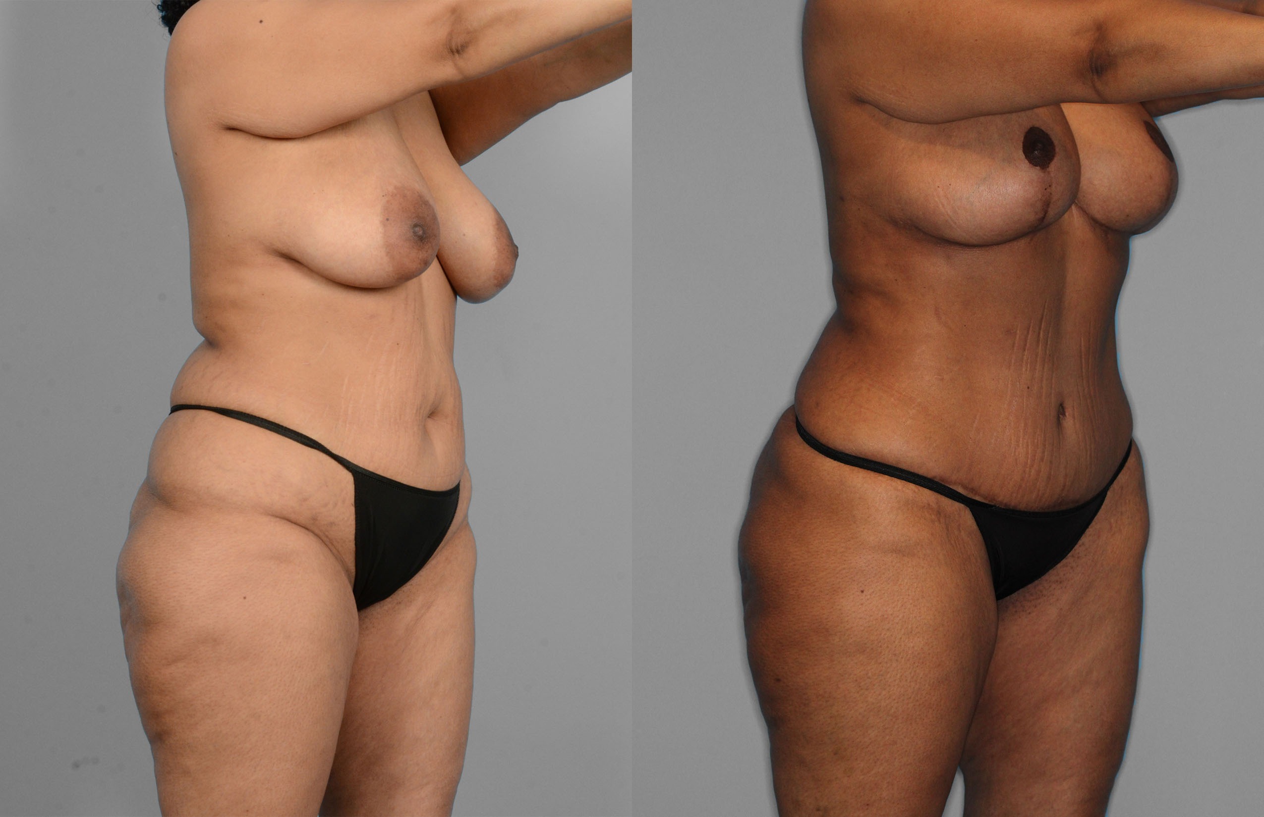 Tummy Tuck Before and After photo by Dr. Abigail Rodriguez in Houston, TX