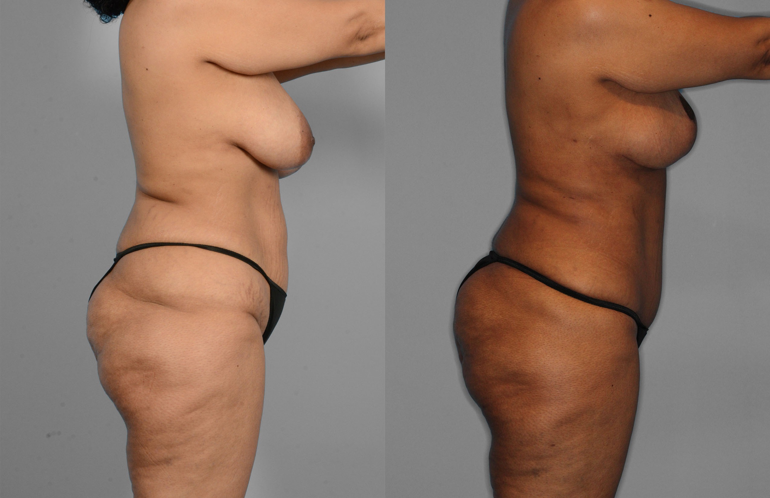 Tummy Tuck Before and After photo by Dr. Abigail Rodriguez in Houston, TX