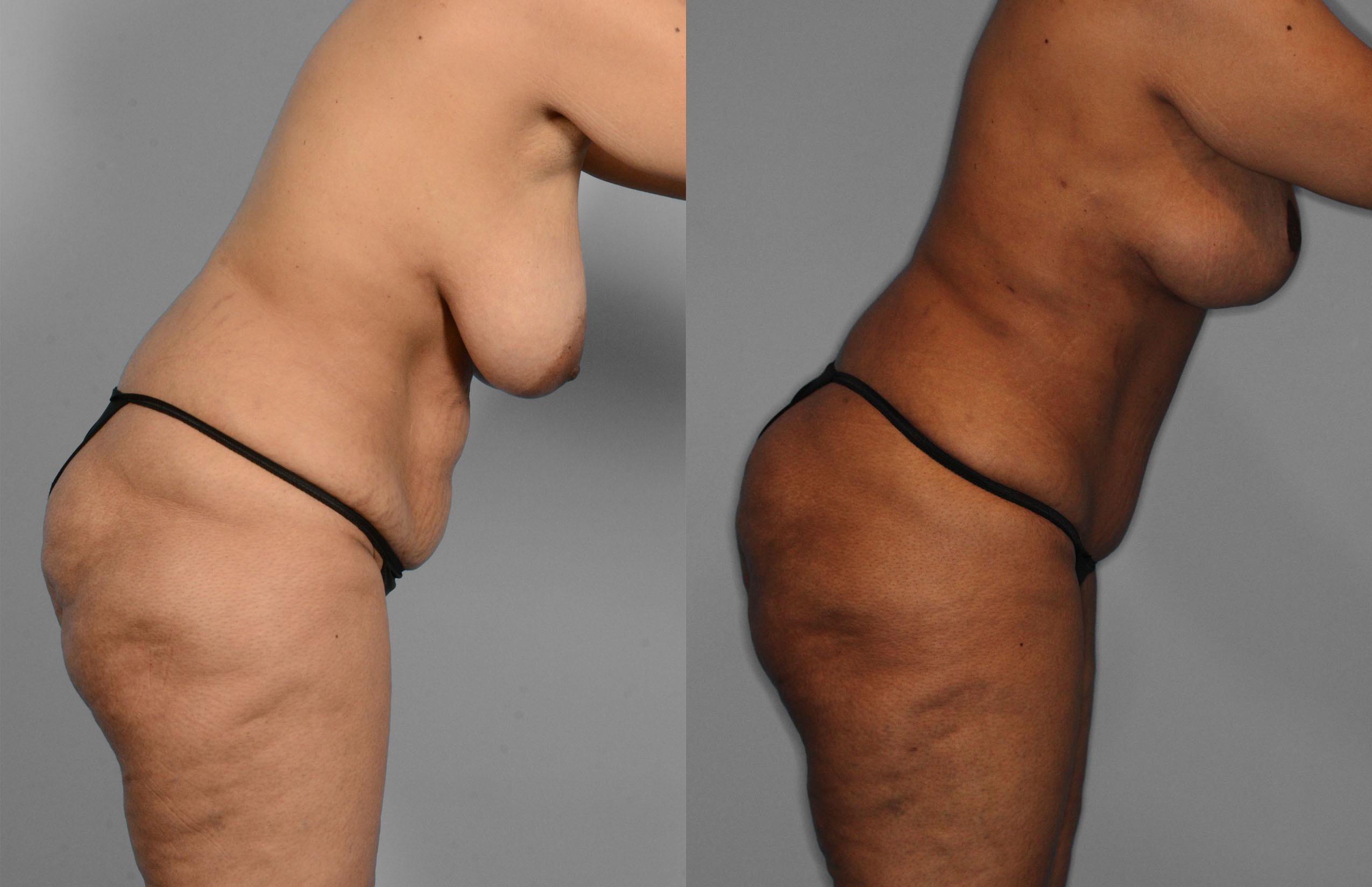 Tummy Tuck Before and After photo by Dr. Abigail Rodriguez in Houston, TX