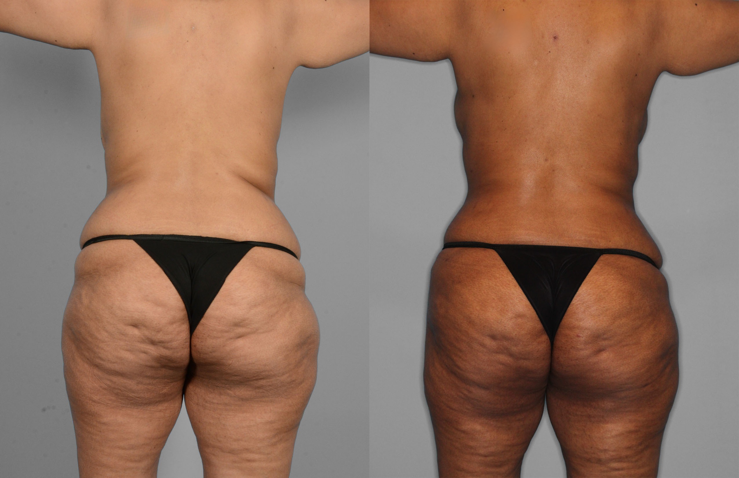 Tummy Tuck Before and After photo by Dr. Abigail Rodriguez in Houston, TX