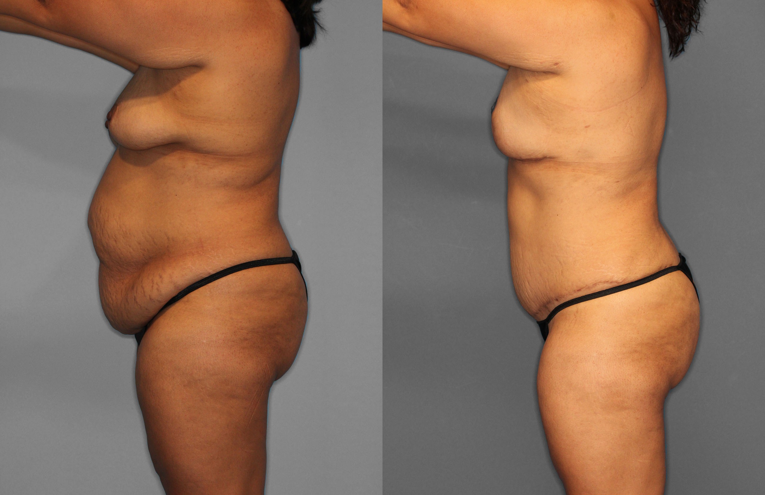 Tummy Tuck Before and After photo by Dr. Abigail Rodriguez in Houston, TX