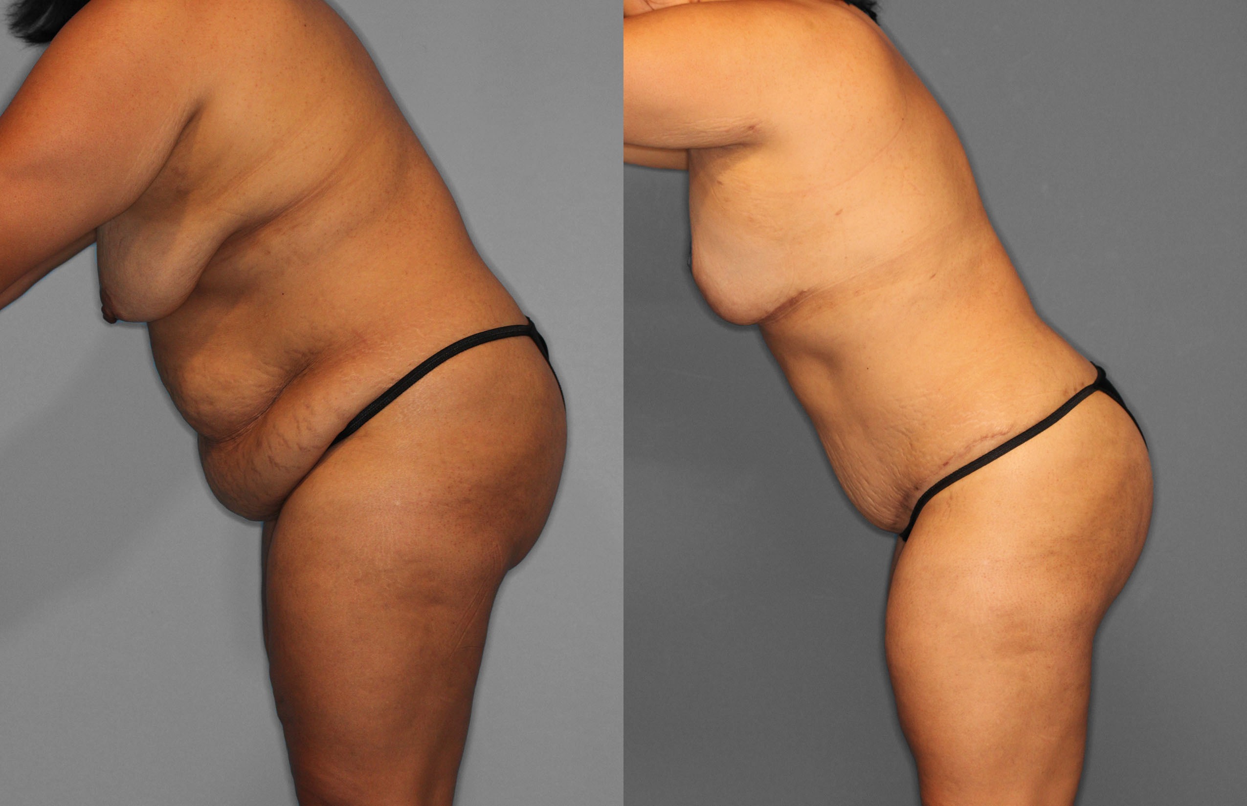 Tummy Tuck Before and After photo by Dr. Abigail Rodriguez in Houston, TX