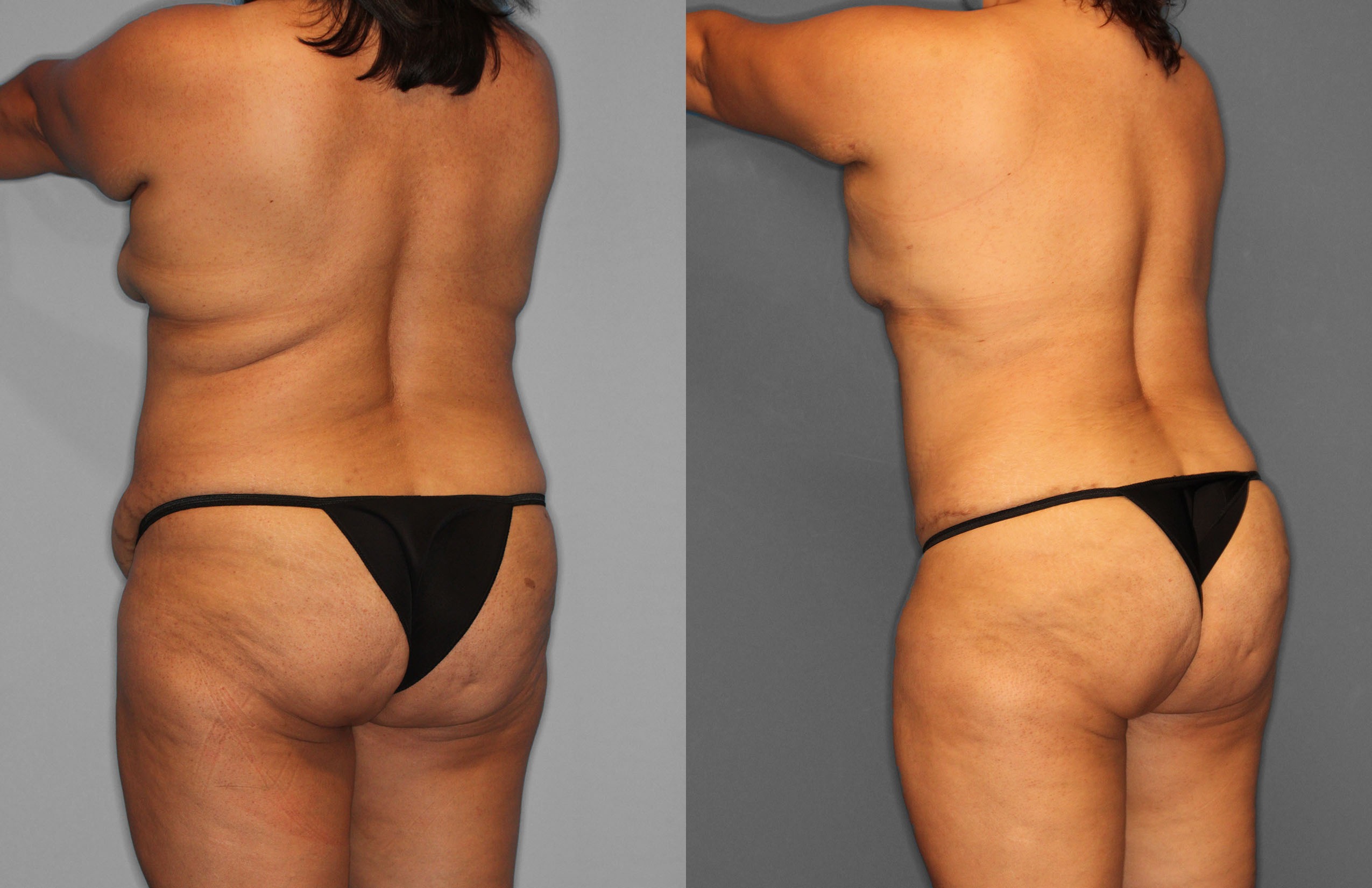 Tummy Tuck Before and After photo by Dr. Abigail Rodriguez in Houston, TX