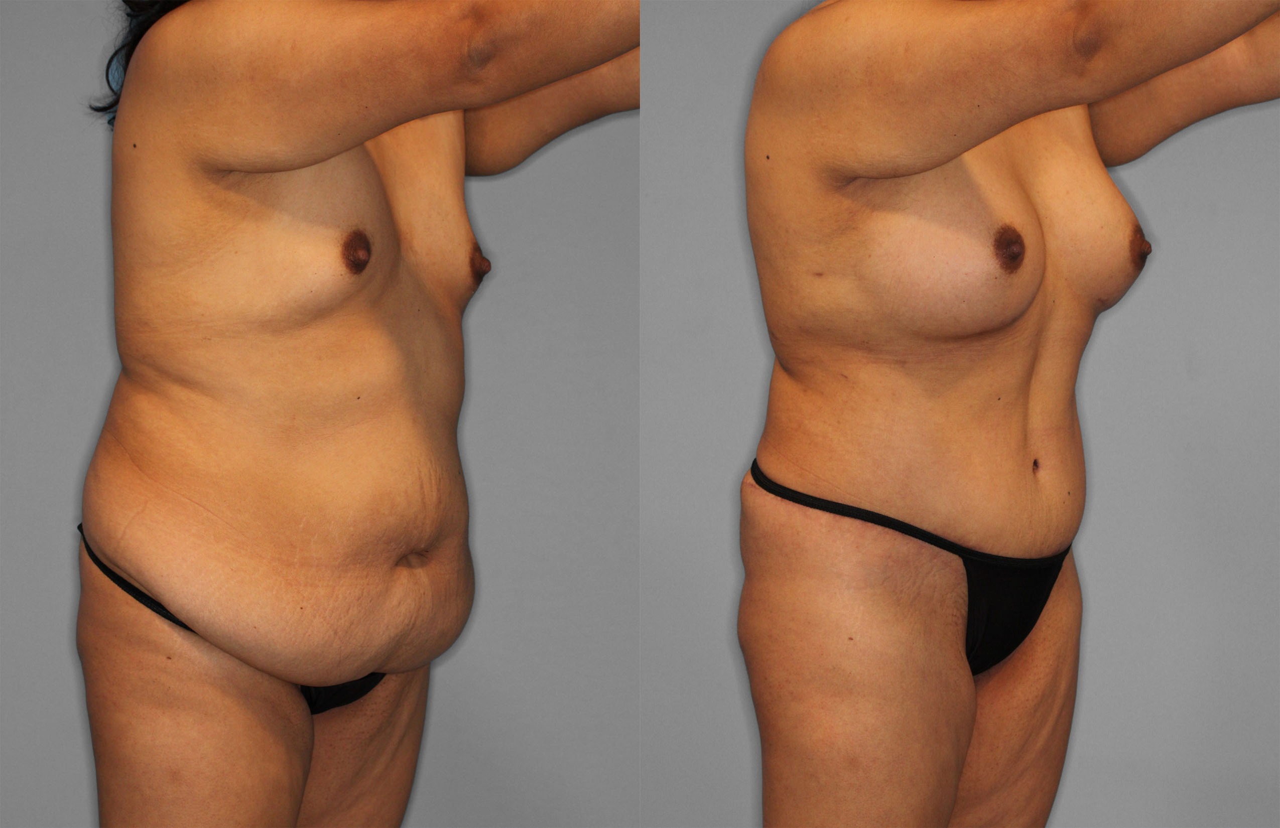 Tummy Tuck Before and After photo by Dr. Abigail Rodriguez in Houston, TX
