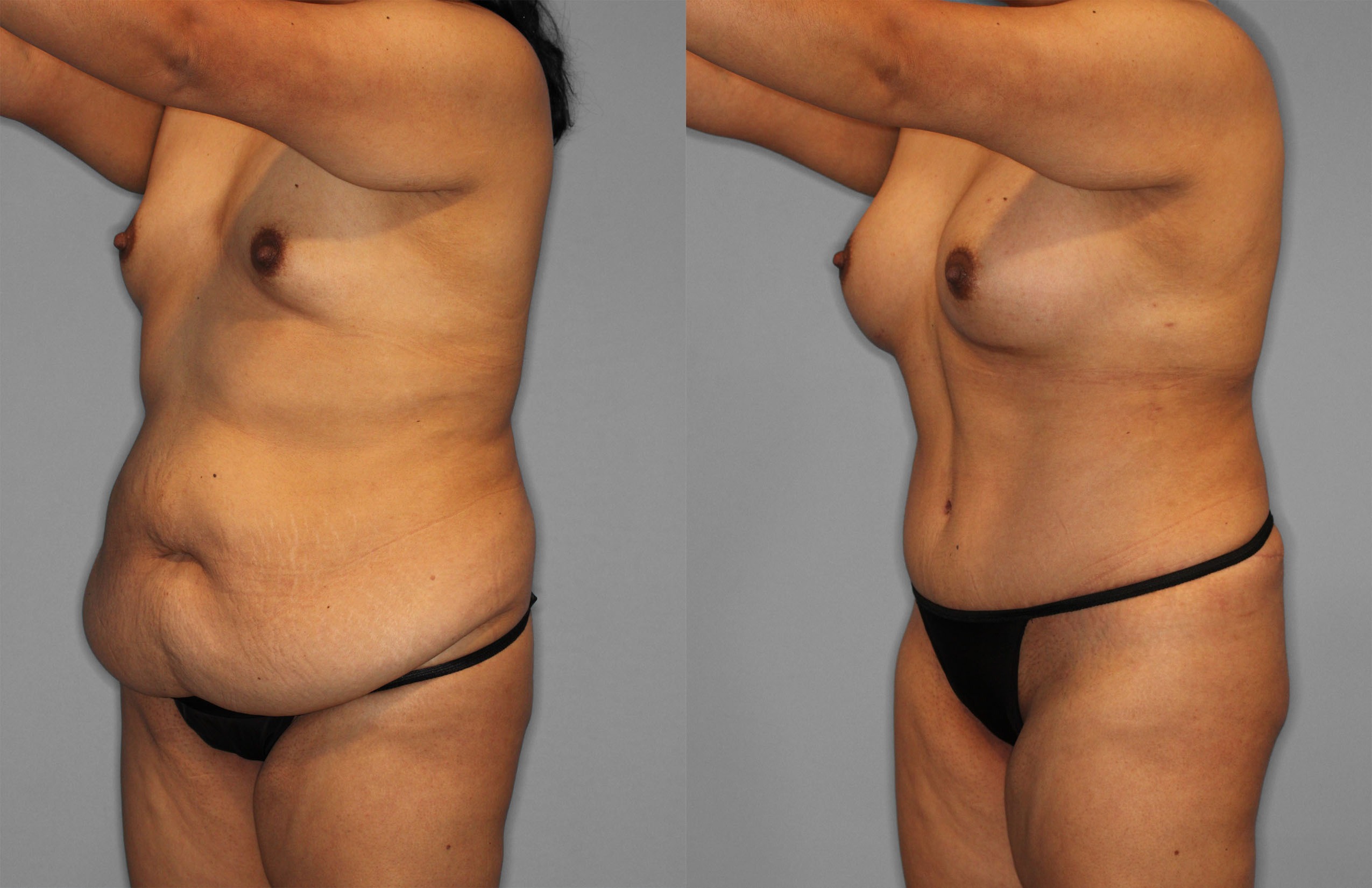 Tummy Tuck Before and After photo by Dr. Abigail Rodriguez in Houston, TX