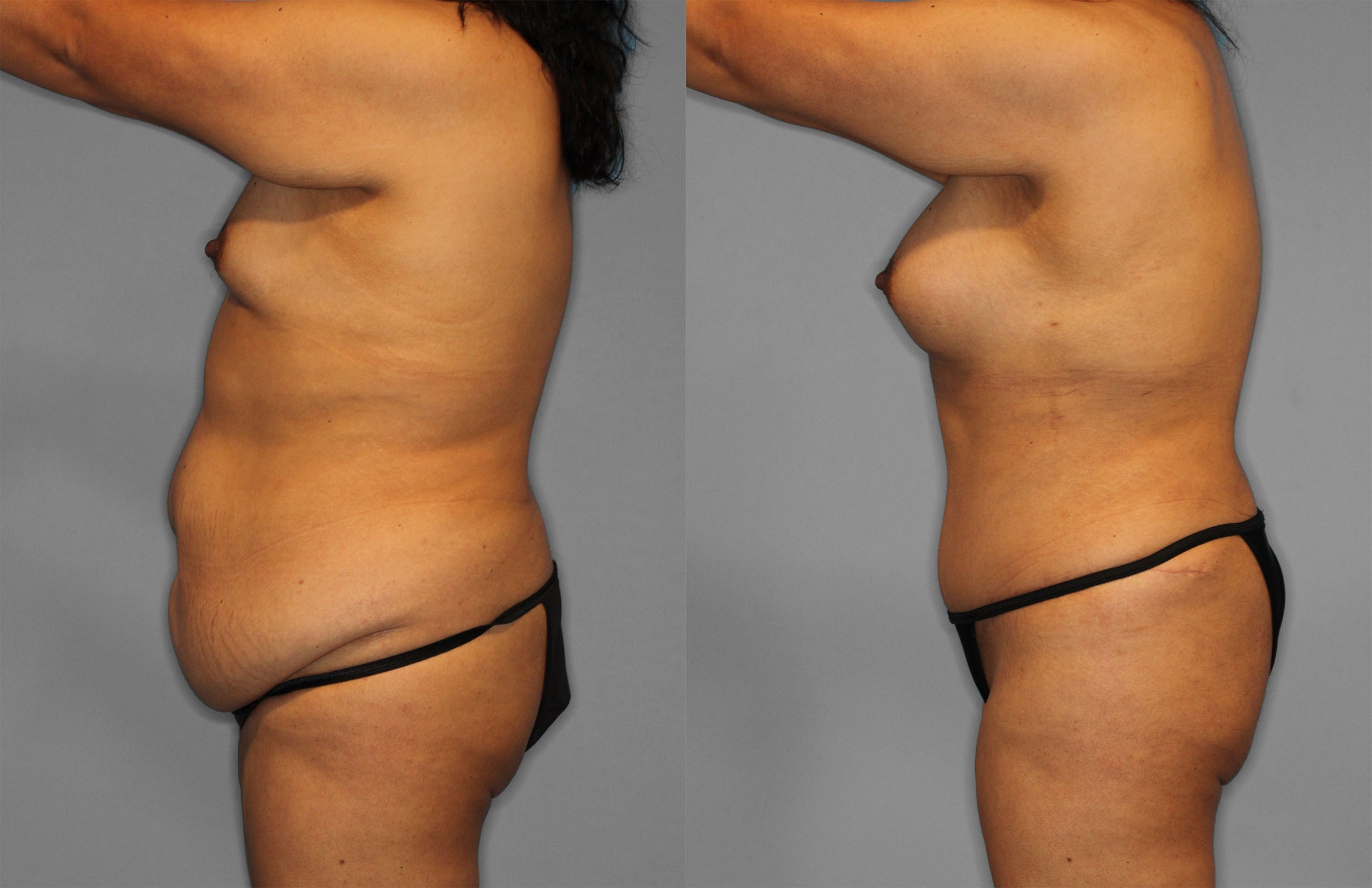Tummy Tuck Before and After photo by Dr. Abigail Rodriguez in Houston, TX