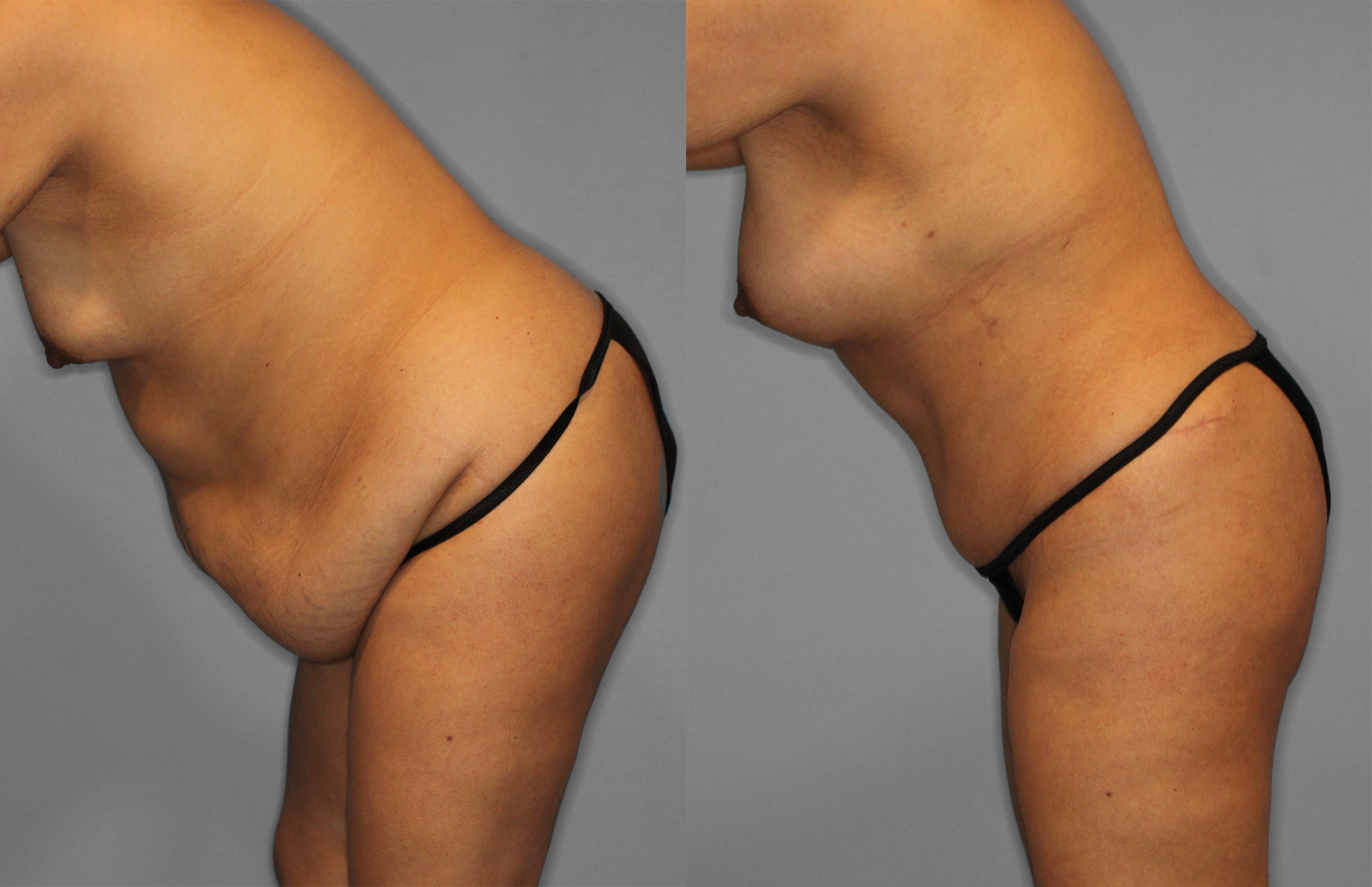 Tummy Tuck Before and After photo by Dr. Abigail Rodriguez in Houston, TX