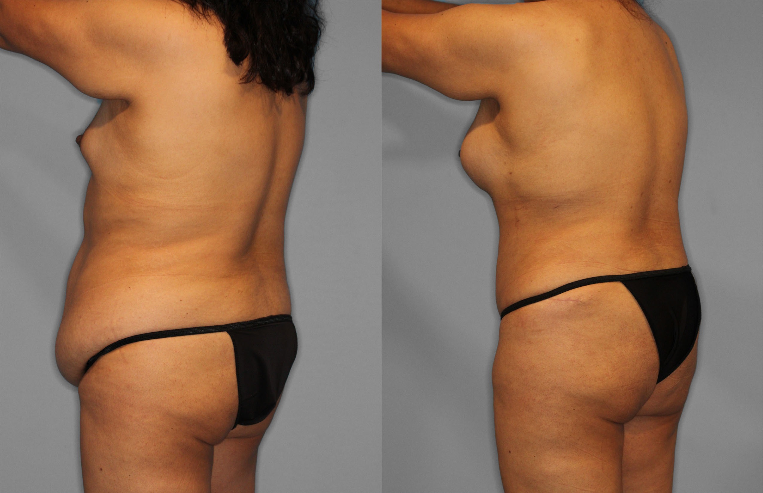 Tummy Tuck Before and After photo by Dr. Abigail Rodriguez in Houston, TX