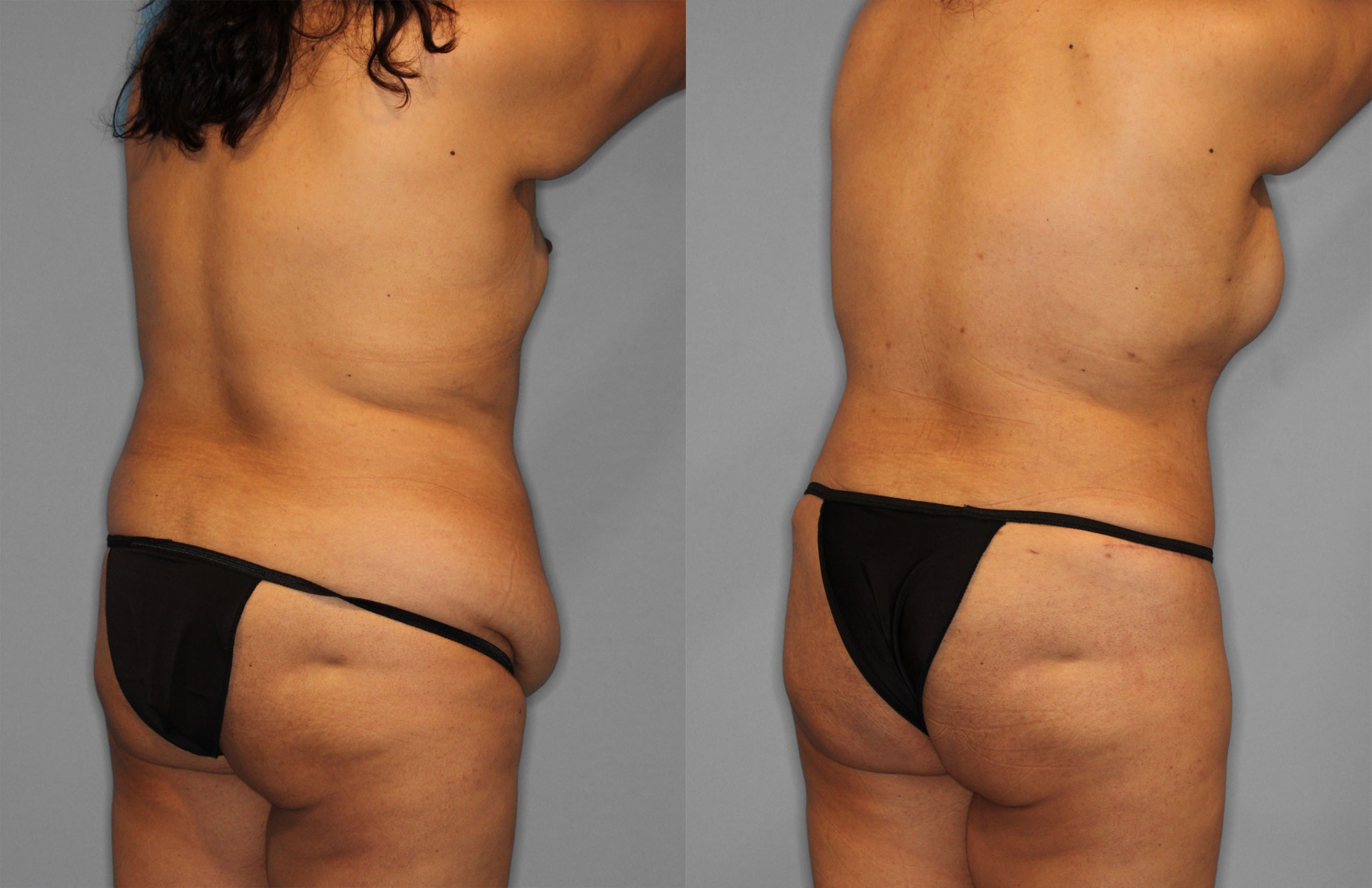 Tummy Tuck Before and After photo by Dr. Abigail Rodriguez in Houston, TX