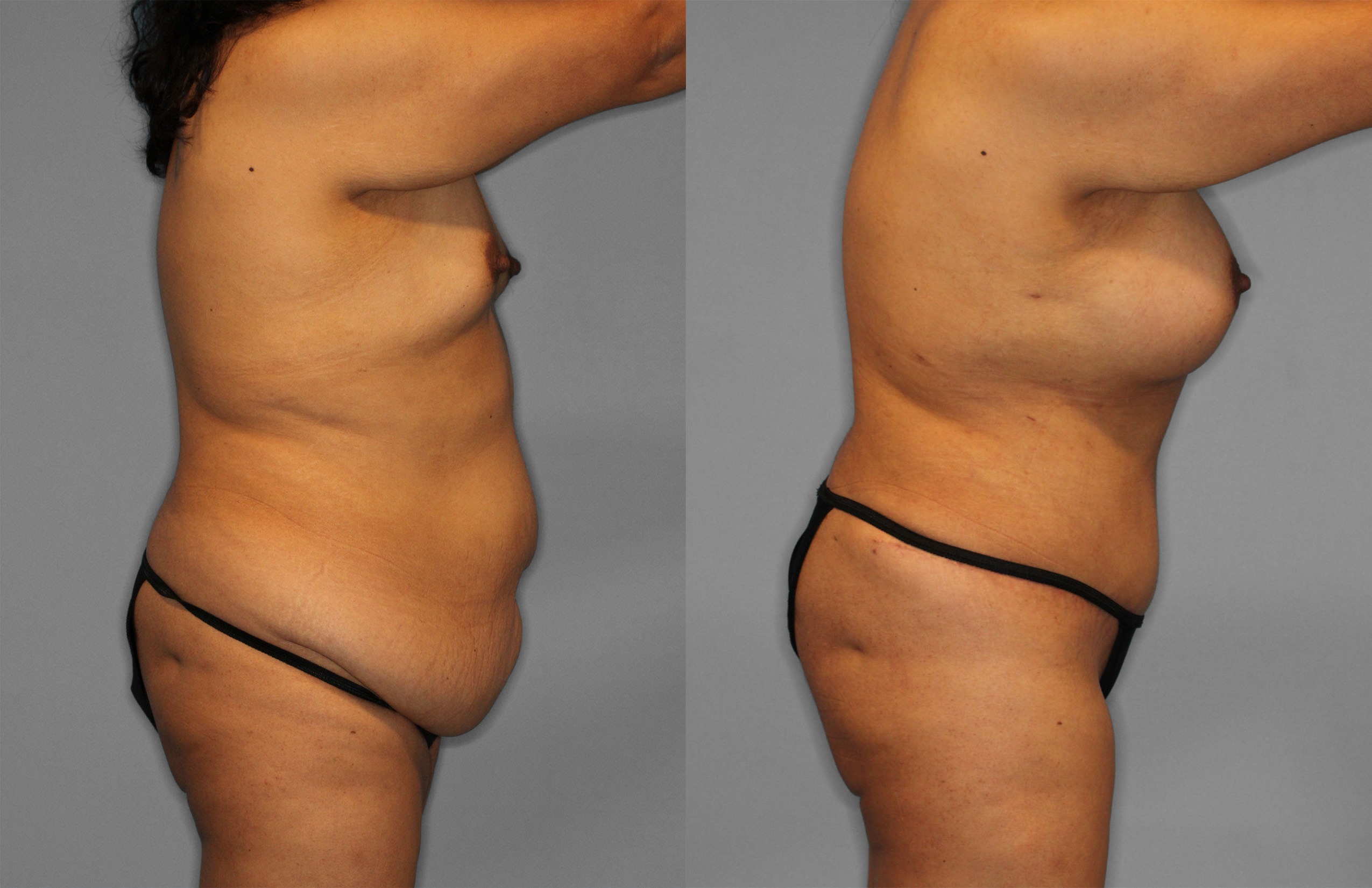 Tummy Tuck Before and After photo by Dr. Abigail Rodriguez in Houston, TX
