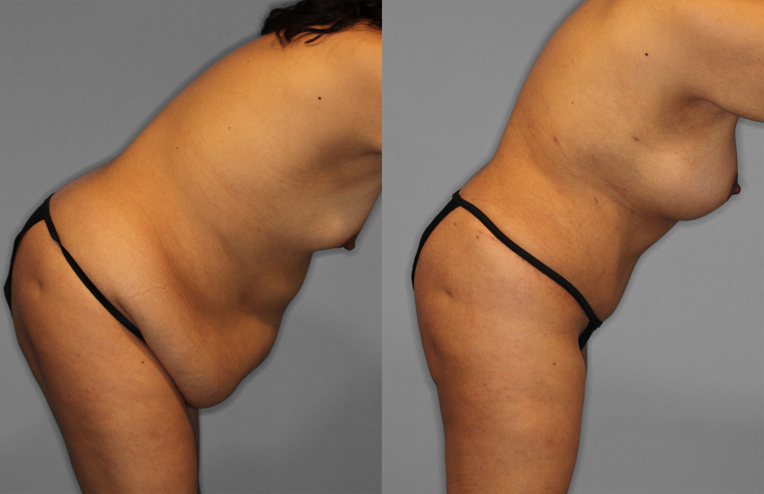 Tummy Tuck Before and After photo by Dr. Abigail Rodriguez in Houston, TX
