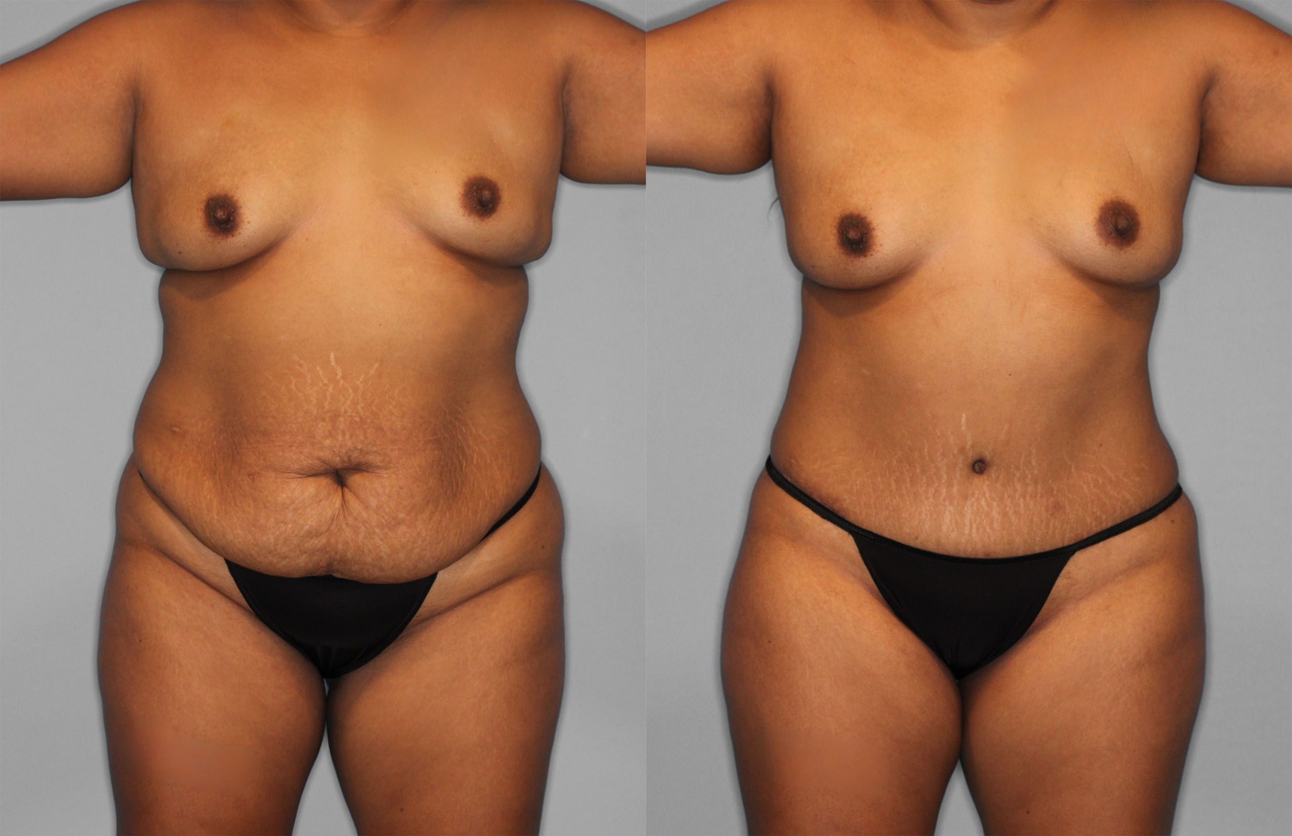Tummy Tuck Before and After photo by Dr. Abigail Rodriguez in Houston, TX