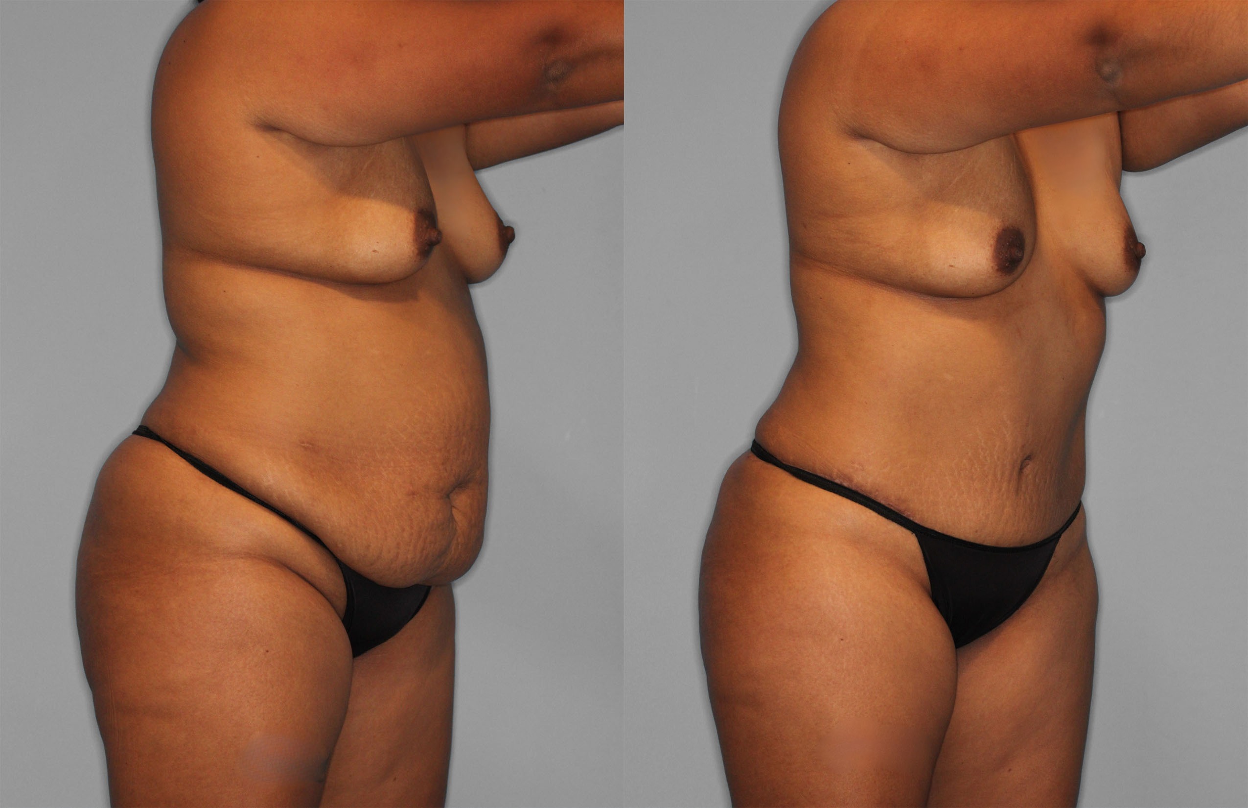 Tummy Tuck Before and After photo by Dr. Abigail Rodriguez in Houston, TX