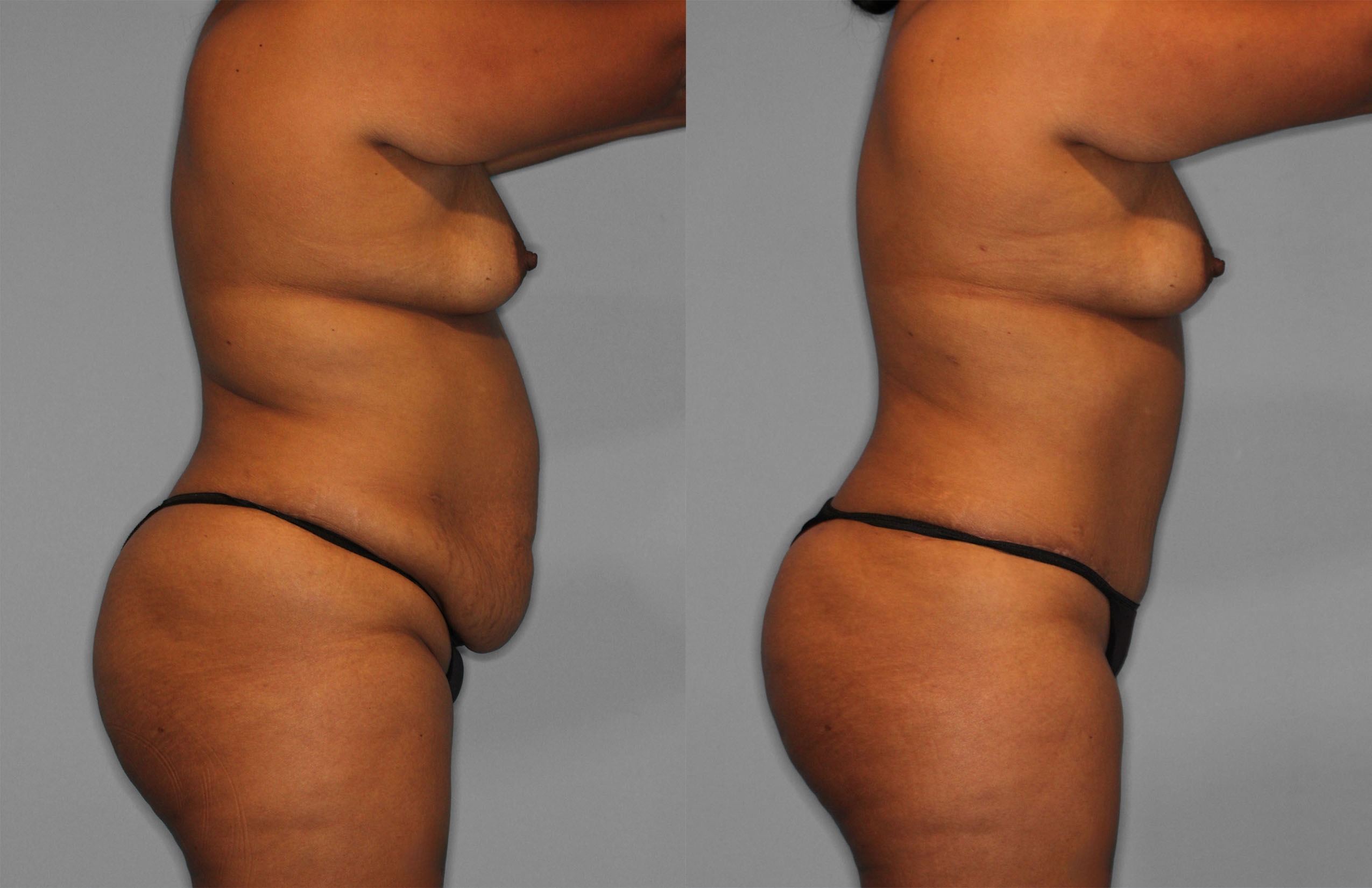 Tummy Tuck Before and After photo by Dr. Abigail Rodriguez in Houston, TX