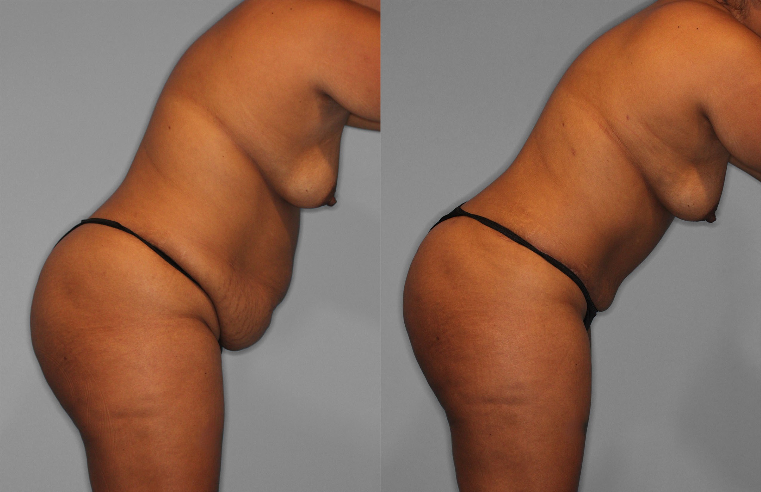 Tummy Tuck Before and After photo by Dr. Abigail Rodriguez in Houston, TX