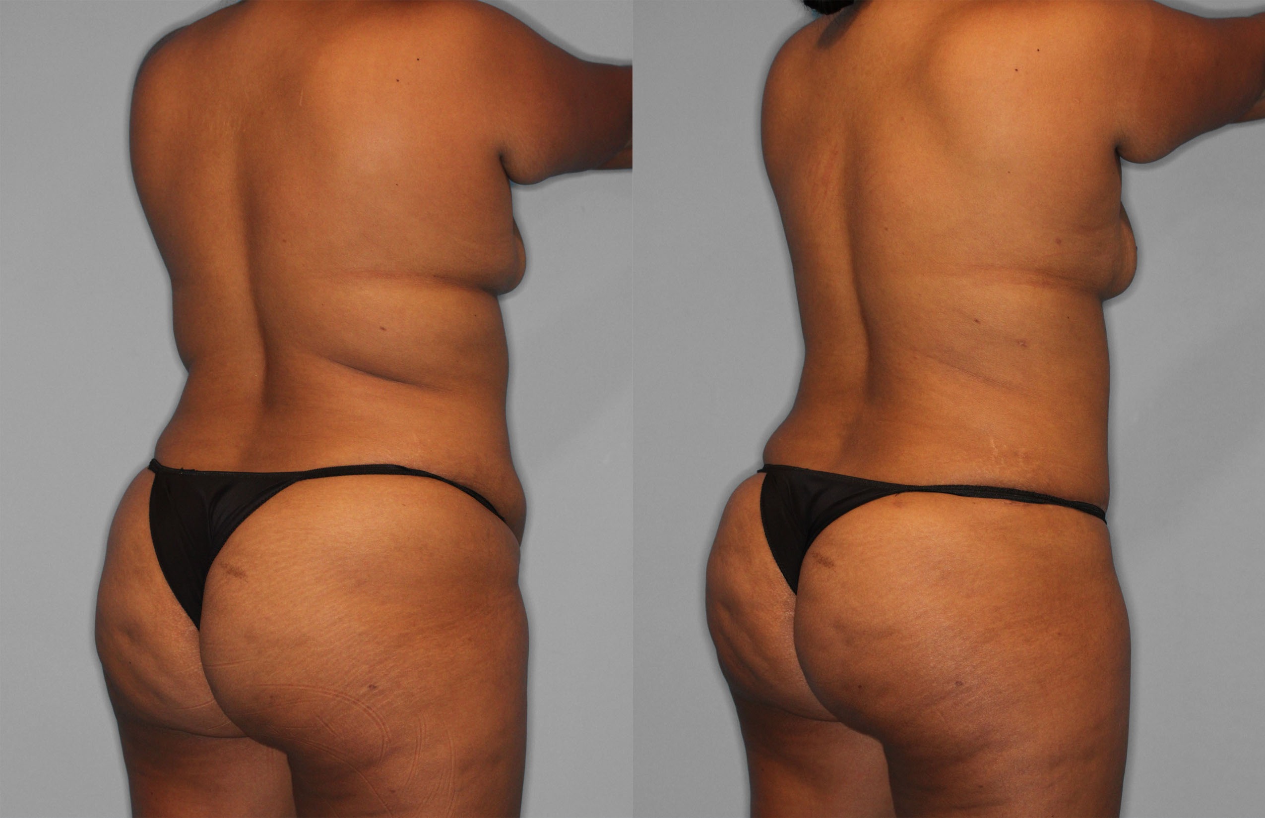 Tummy Tuck Before and After photo by Dr. Abigail Rodriguez in Houston, TX