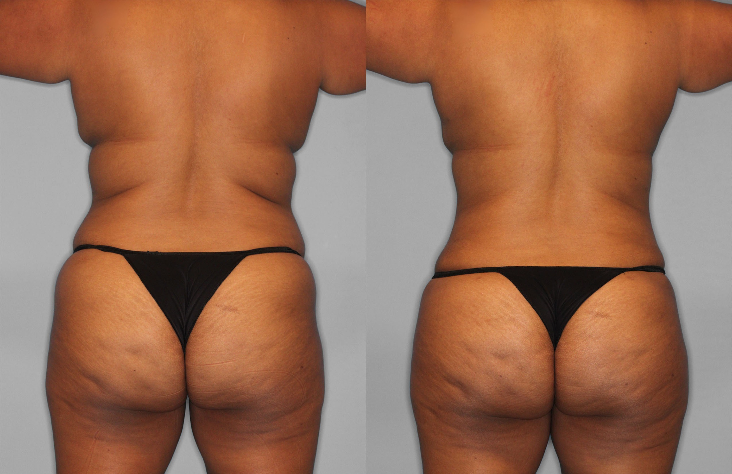 Tummy Tuck Before and After photo by Dr. Abigail Rodriguez in Houston, TX