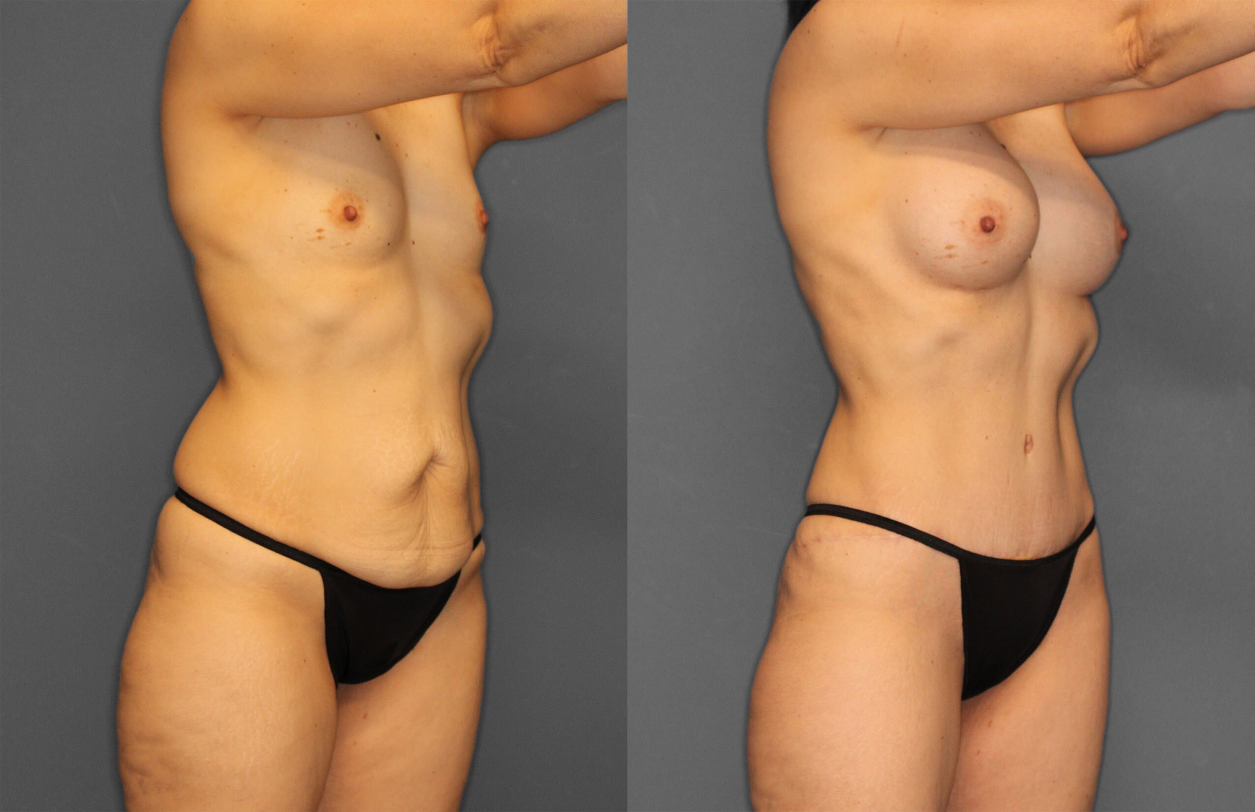 Tummy Tuck Before and After photo by Dr. Abigail Rodriguez in Houston, TX