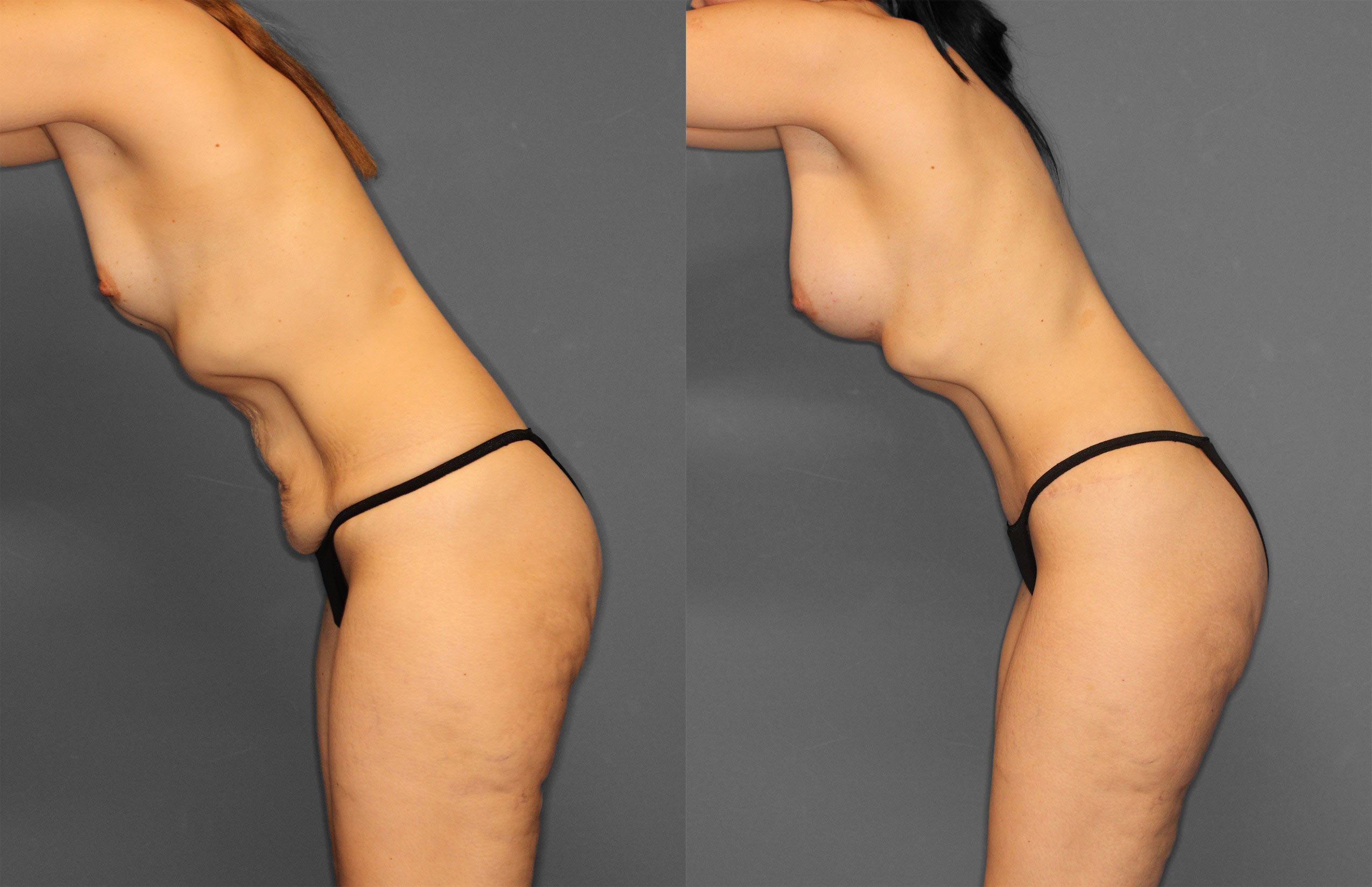 Tummy Tuck Before and After photo by Dr. Abigail Rodriguez in Houston, TX