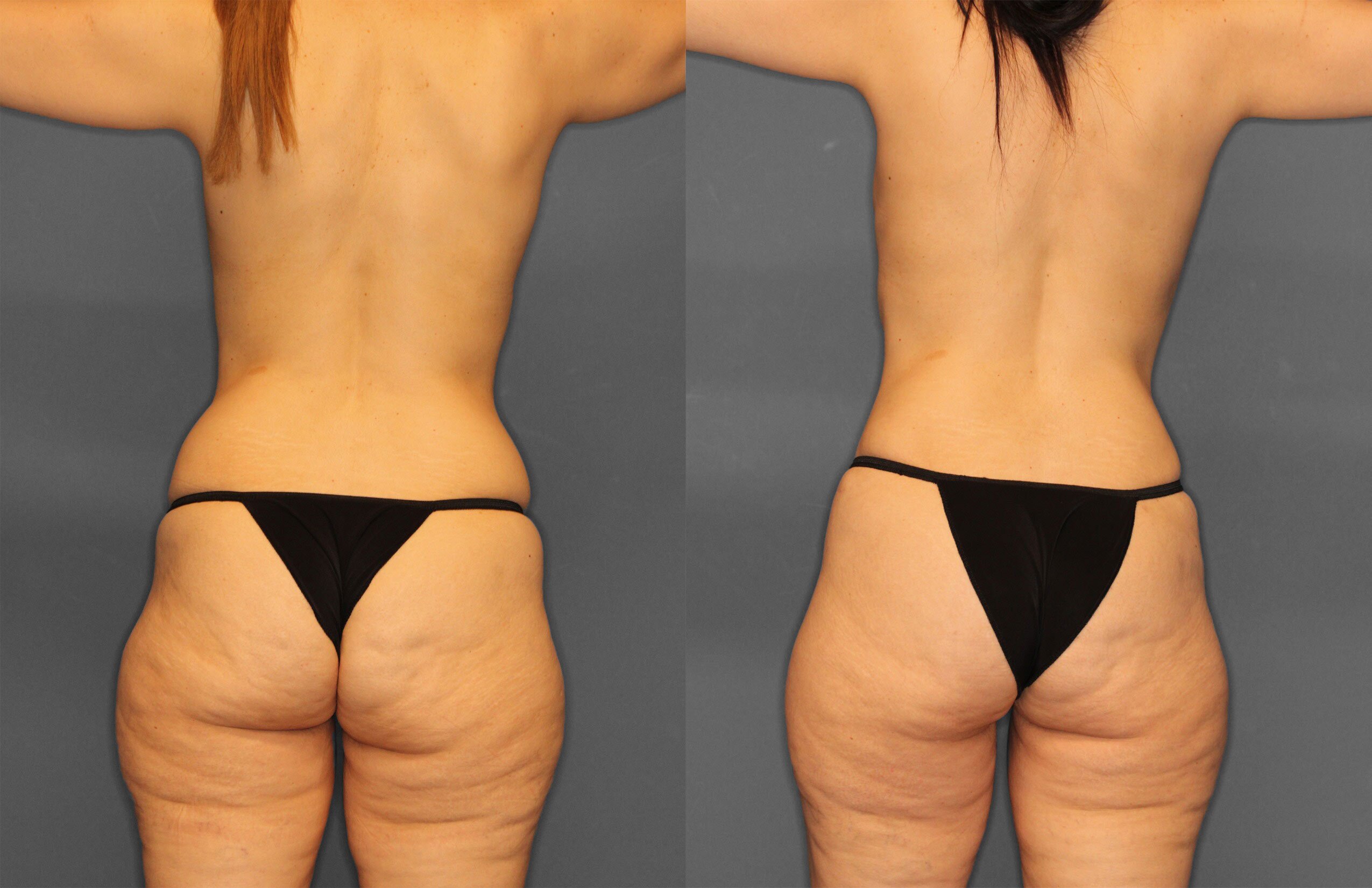 Tummy Tuck Before and After photo by Dr. Abigail Rodriguez in Houston, TX
