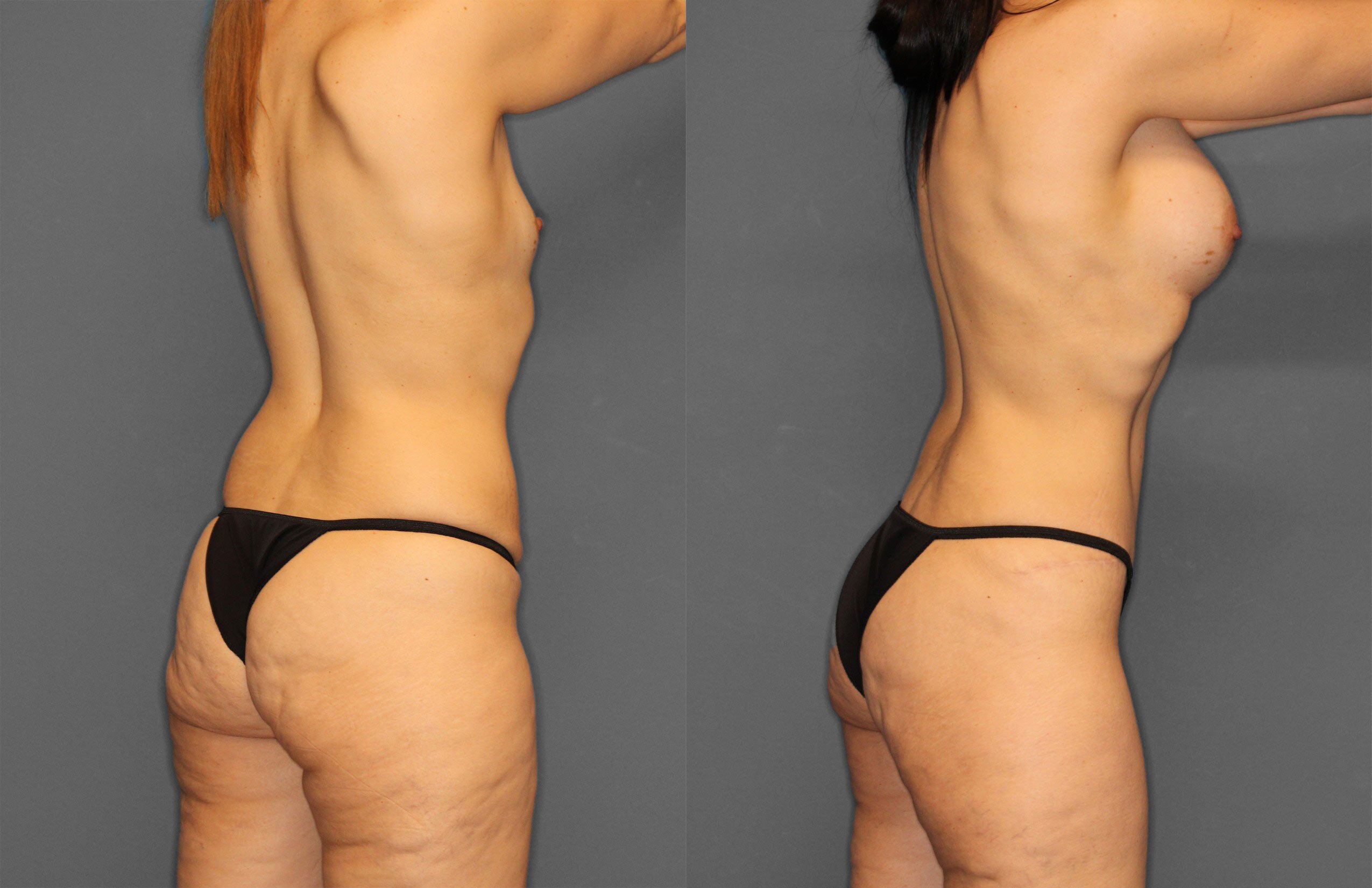 Tummy Tuck Before and After photo by Dr. Abigail Rodriguez in Houston, TX