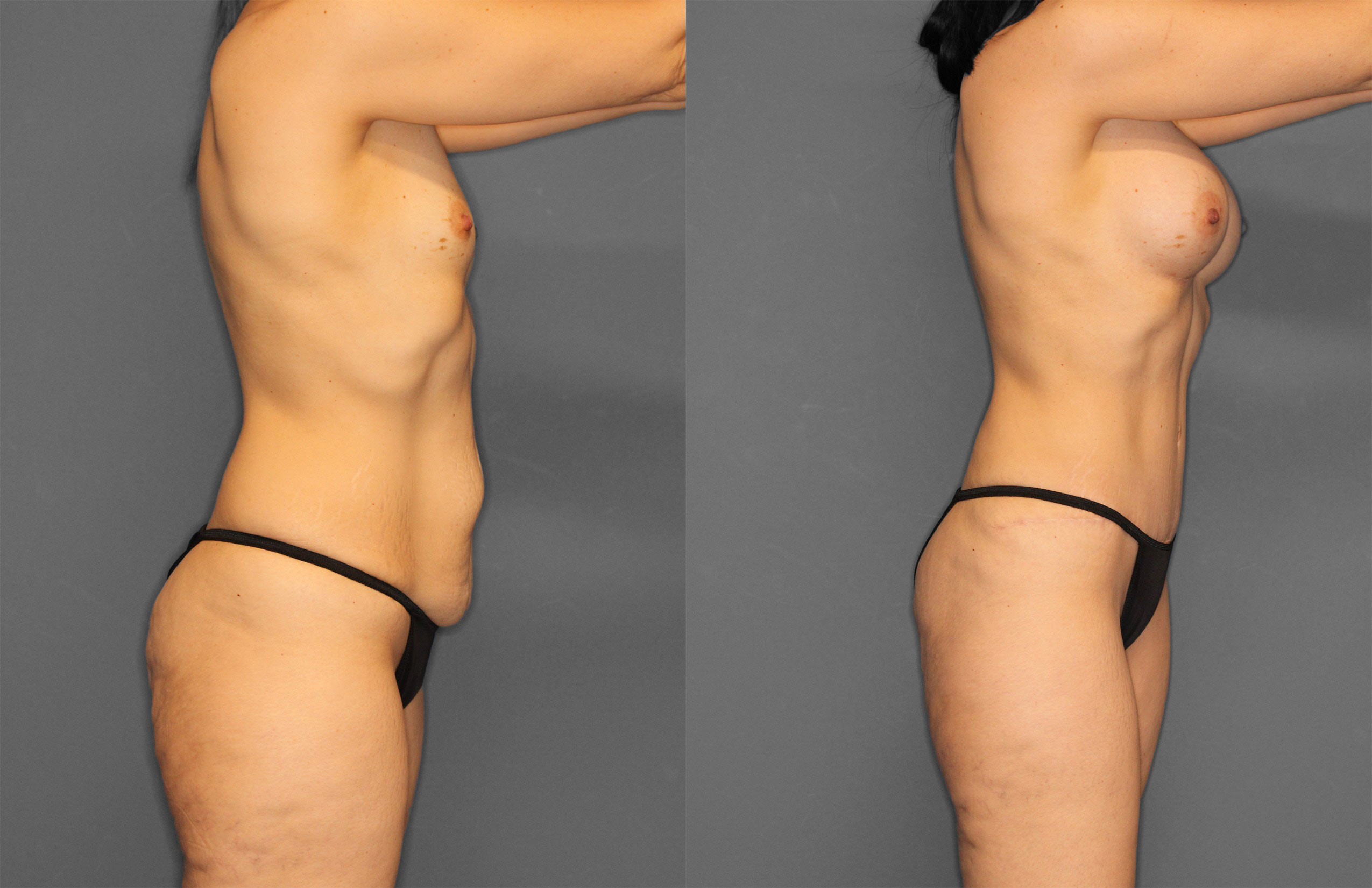 Tummy Tuck Before and After photo by Dr. Abigail Rodriguez in Houston, TX