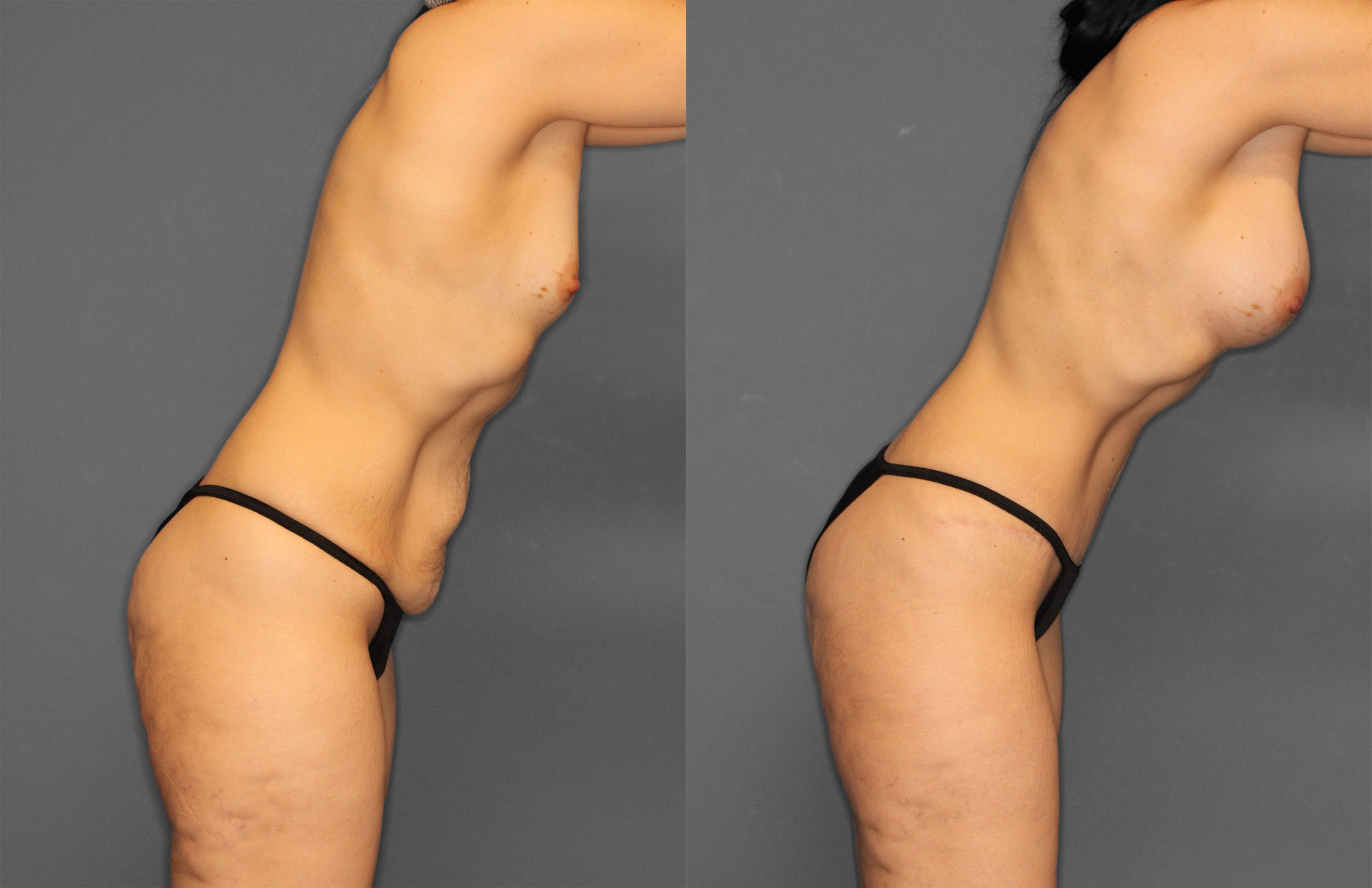 Tummy Tuck Before and After photo by Dr. Abigail Rodriguez in Houston, TX