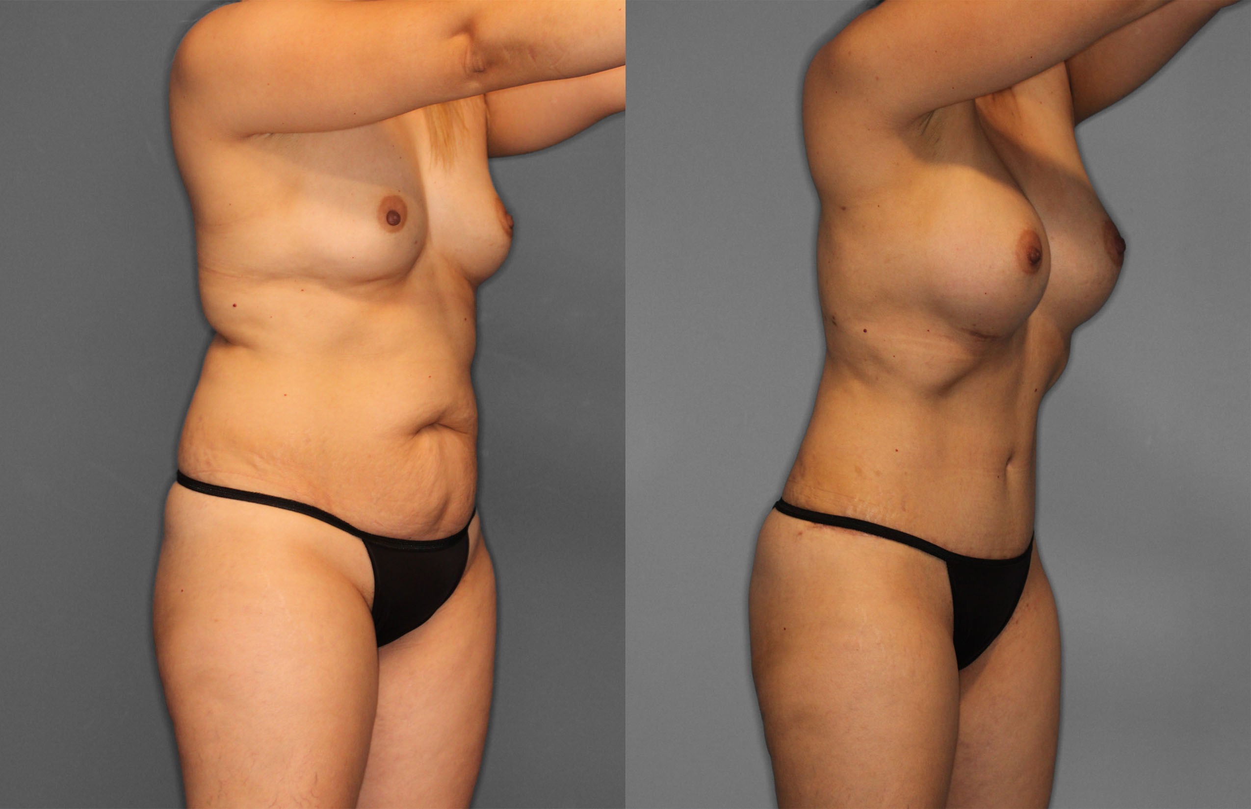 Tummy Tuck Before and After photo by Dr. Abigail Rodriguez in Houston, TX