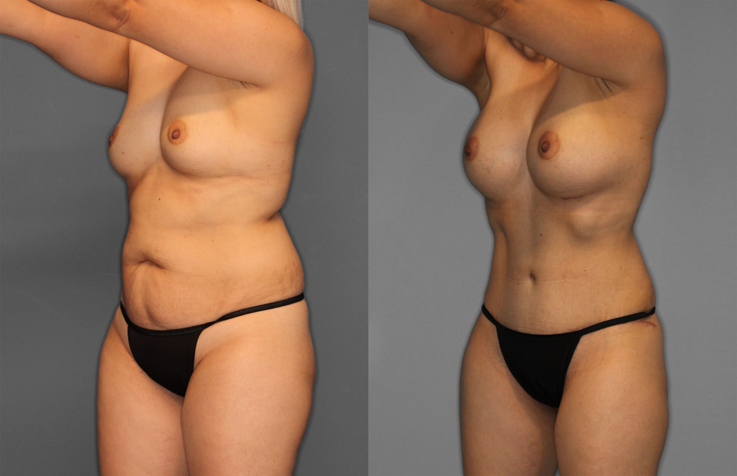 Tummy Tuck Before and After photo by Dr. Abigail Rodriguez in Houston, TX