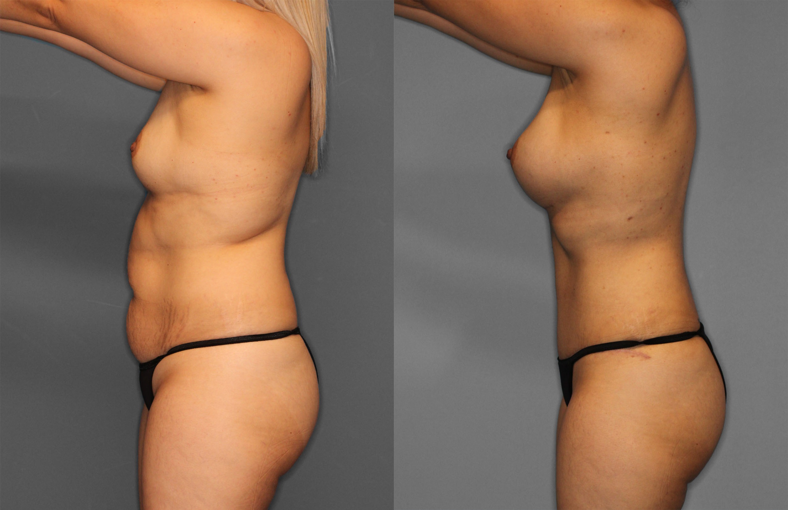 Tummy Tuck Before and After photo by Dr. Abigail Rodriguez in Houston, TX