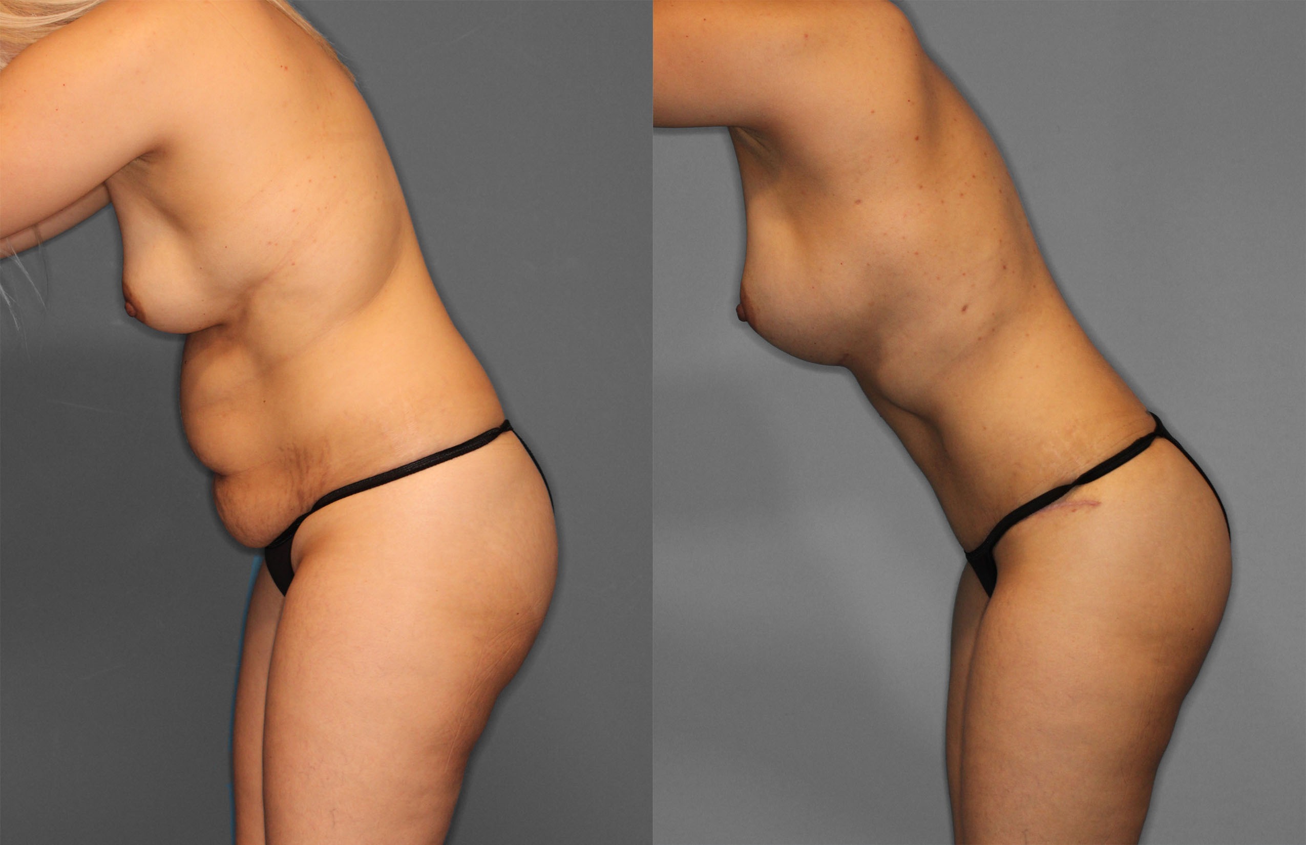 Tummy Tuck Before and After photo by Dr. Abigail Rodriguez in Houston, TX