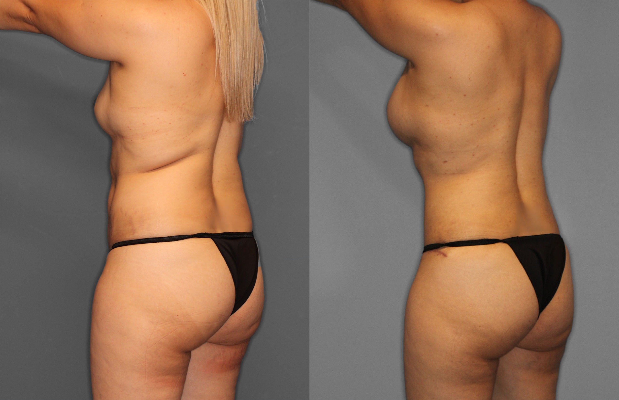 Tummy Tuck Before and After photo by Dr. Abigail Rodriguez in Houston, TX