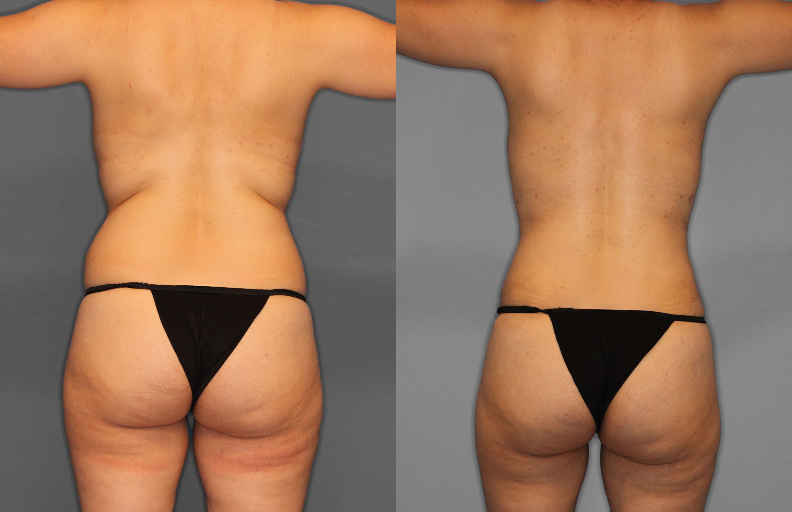 Tummy Tuck Before and After photo by Dr. Abigail Rodriguez in Houston, TX