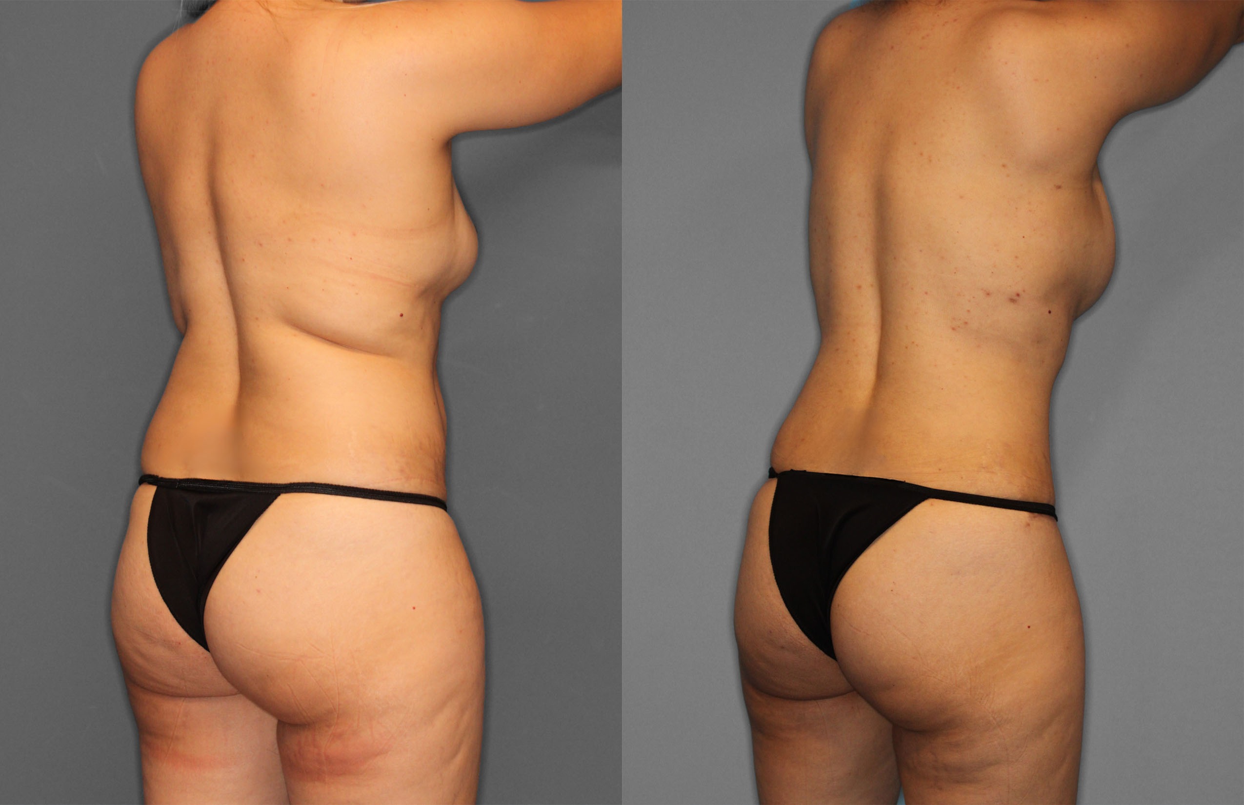 Tummy Tuck Before and After photo by Dr. Abigail Rodriguez in Houston, TX