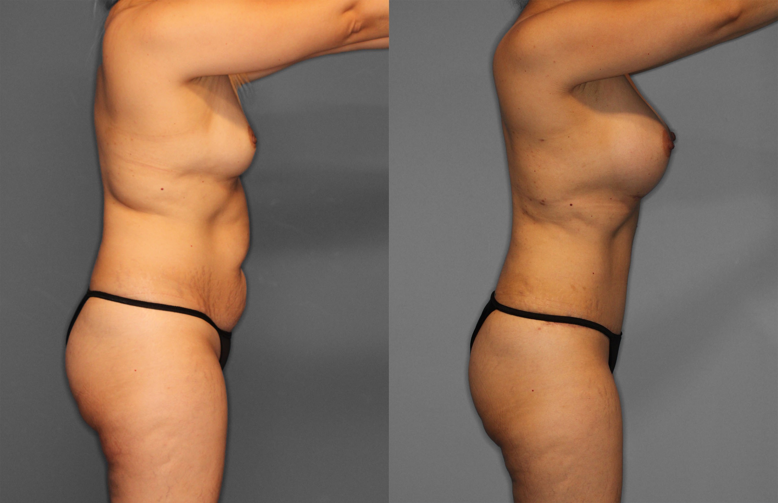 Tummy Tuck Before and After photo by Dr. Abigail Rodriguez in Houston, TX