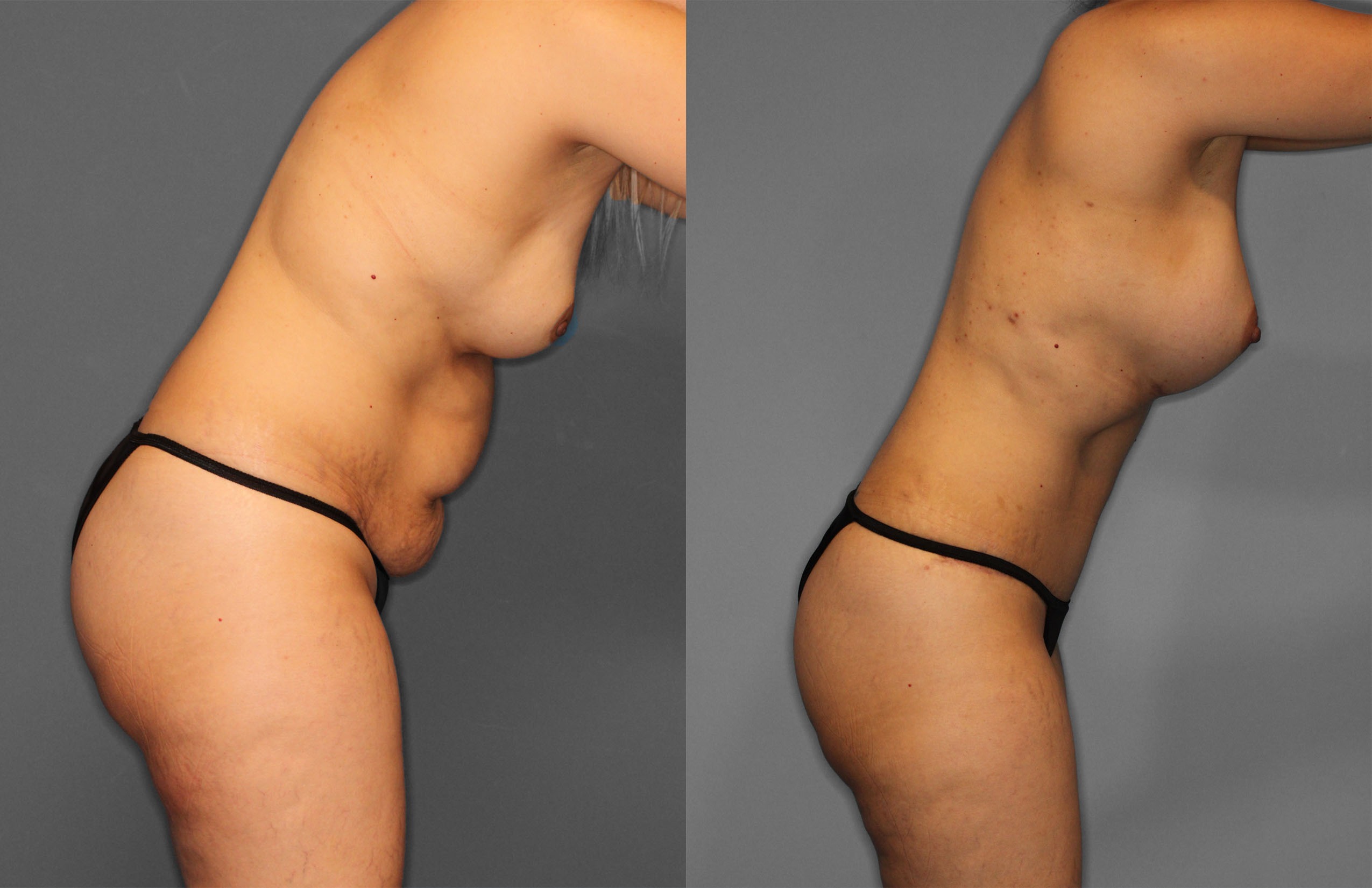 Tummy Tuck Before and After photo by Dr. Abigail Rodriguez in Houston, TX