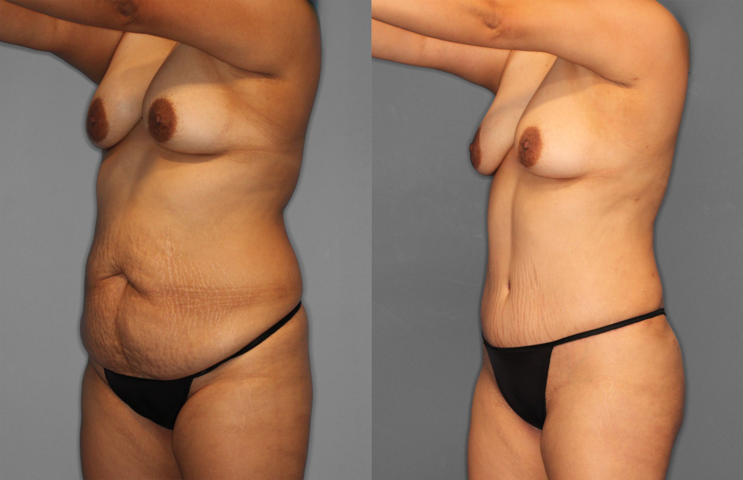 Tummy Tuck & Fat Grafting Before and After photo by Dr. Abigail Rodriguez in Houston, TX