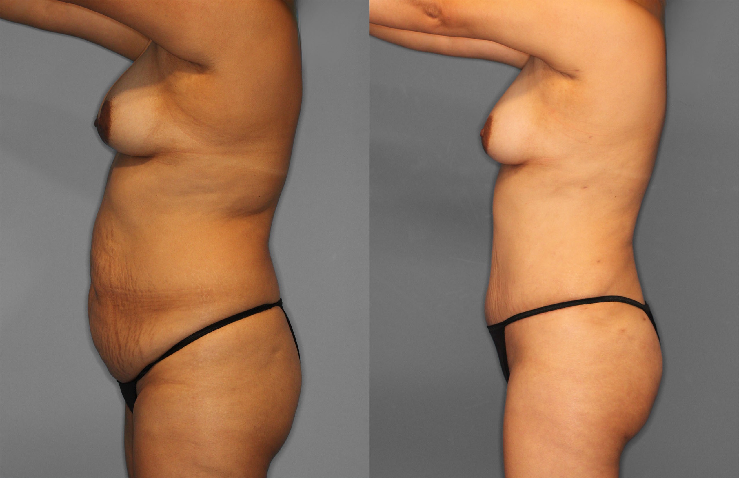 Tummy Tuck & Fat Grafting Before and After photo by Dr. Abigail Rodriguez in Houston, TX