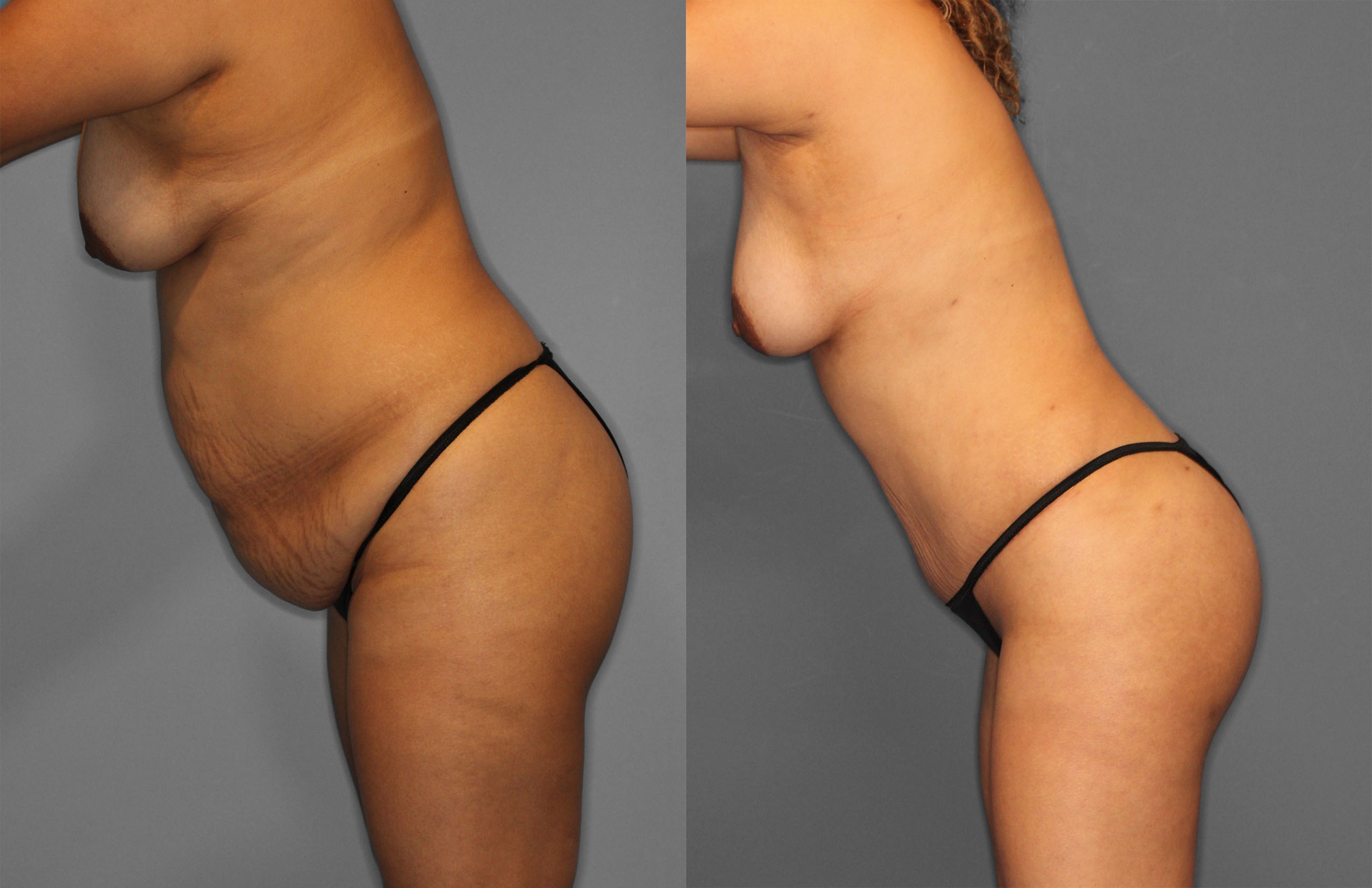 Tummy Tuck & Fat Grafting Before and After photo by Dr. Abigail Rodriguez in Houston, TX