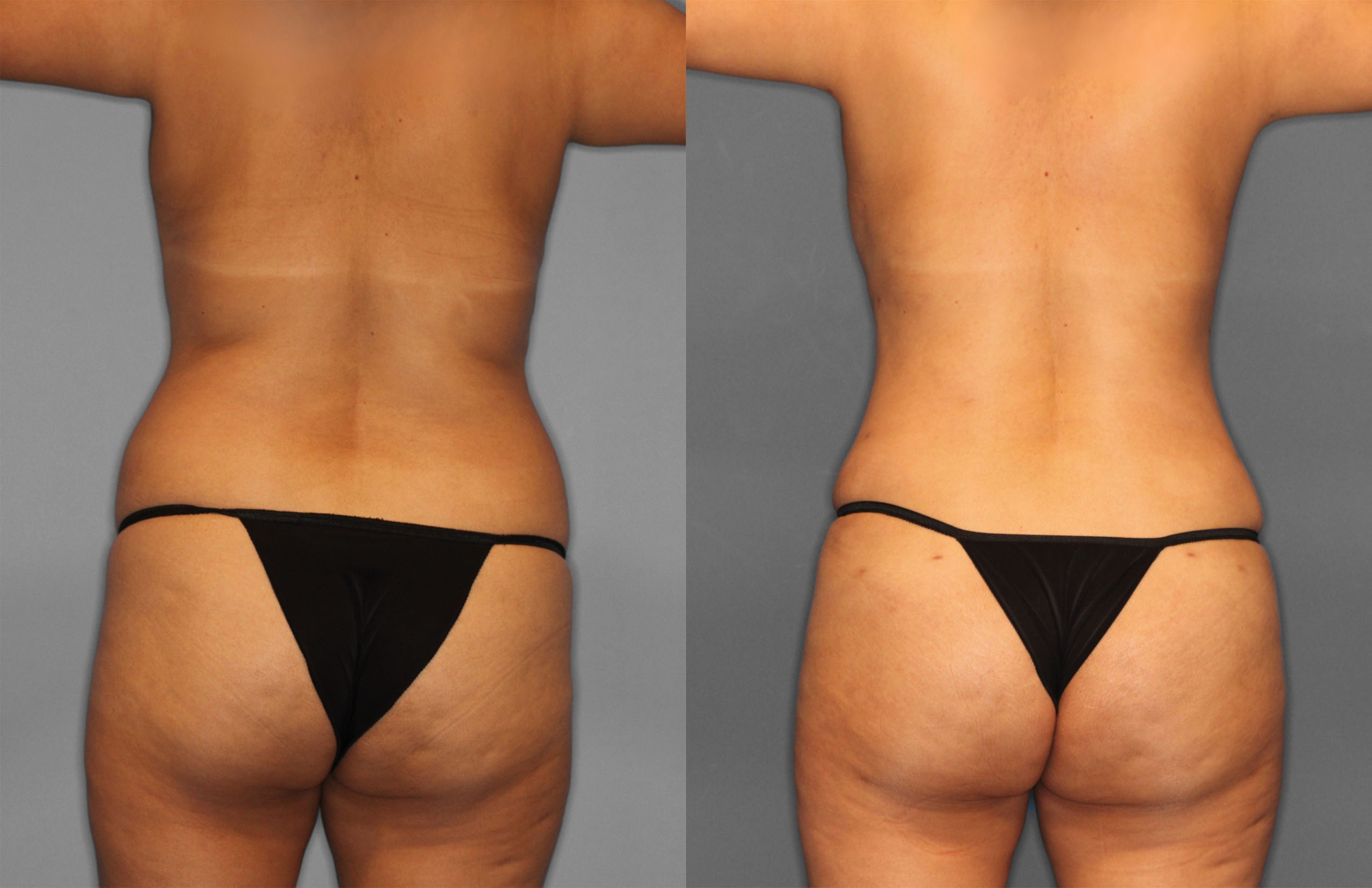Tummy Tuck & Fat Grafting Before and After photo by Dr. Abigail Rodriguez in Houston, TX