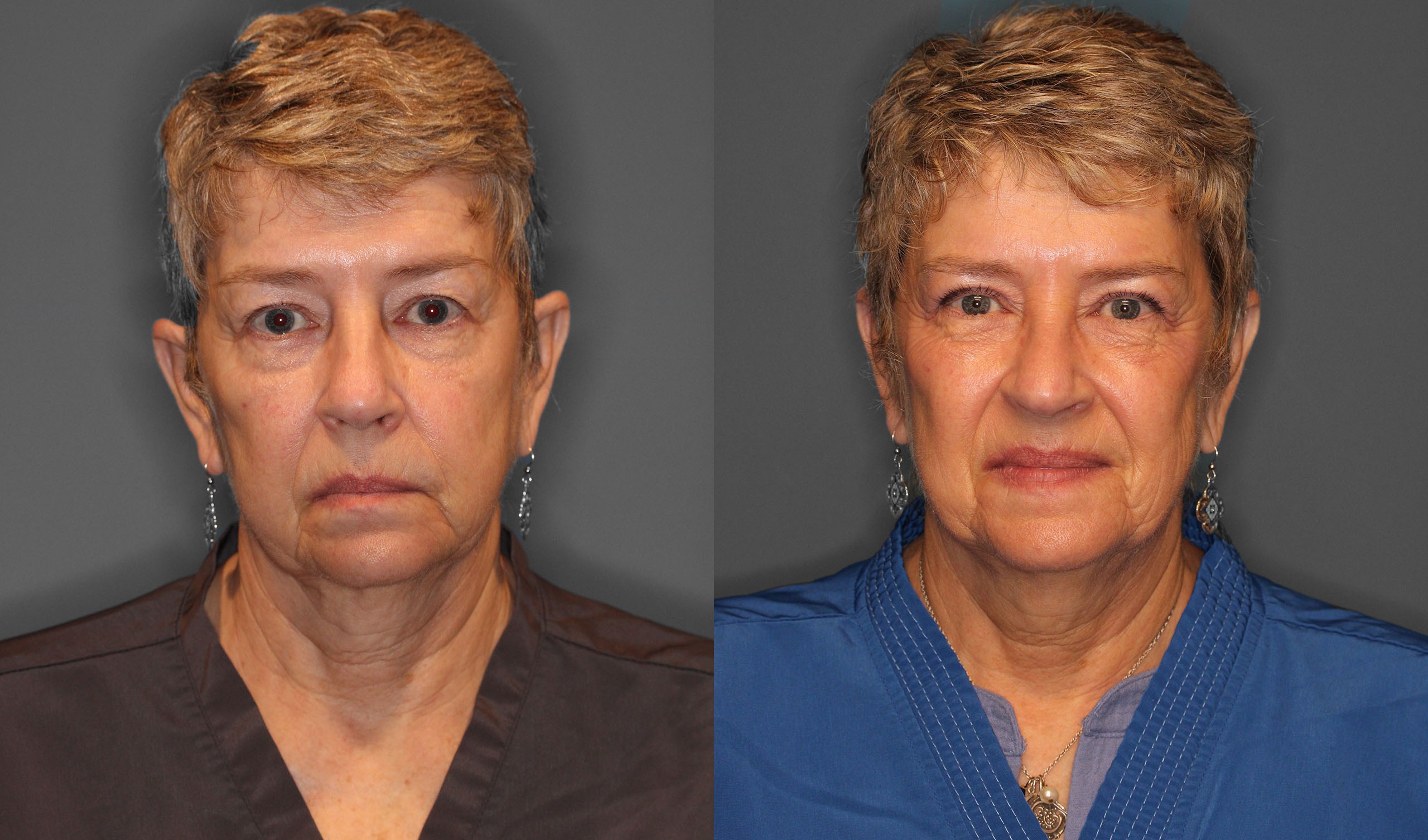Upper Eyelid Lift Before and After photo by Dr. Abigail Rodriguez in Houston, TX