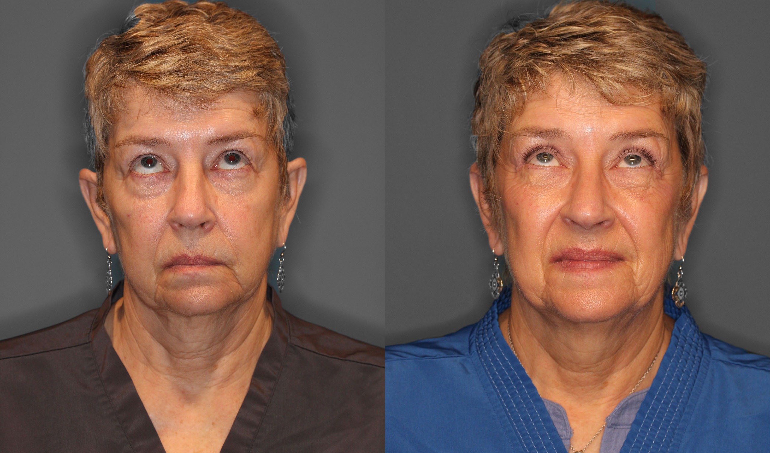 Upper Eyelid Lift Before and After photo by Dr. Abigail Rodriguez in Houston, TX