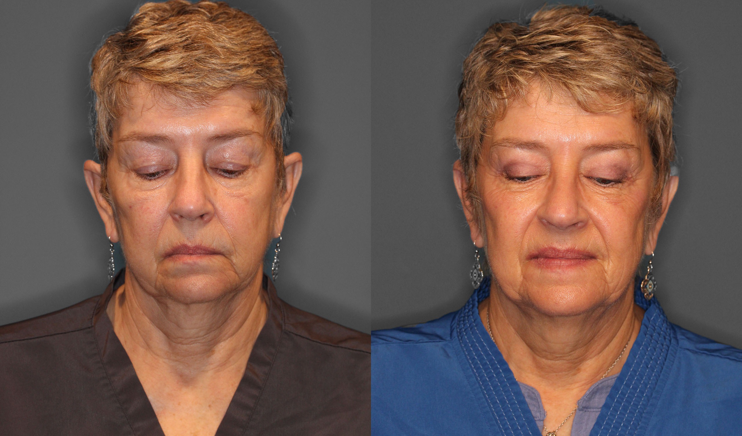 Upper Eyelid Lift Before and After photo by Dr. Abigail Rodriguez in Houston, TX