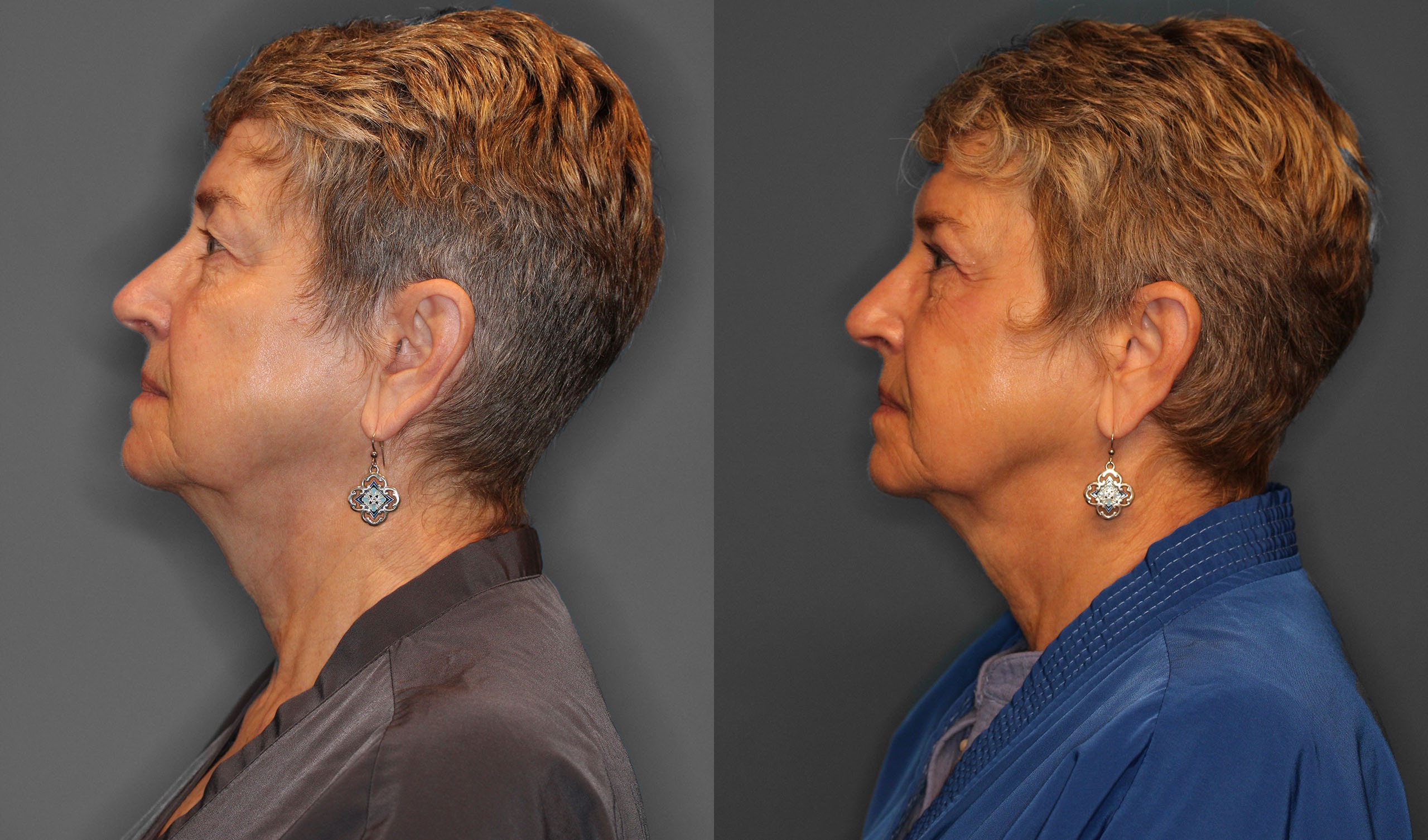Upper Eyelid Lift Before and After photo by Dr. Abigail Rodriguez in Houston, TX